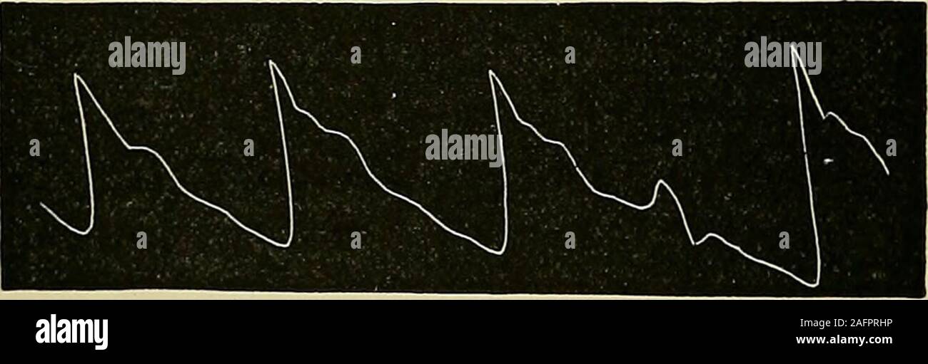 . Les maladies du coeur et l'aorte thoracique. de l'impulsion.-le characterof le pouls dans la sténose mitrale dépend du degré de con-restriction et l'état du tissu musculaire du cœur, plus particulièrement de l'auricule gauche. Lorsque la sténose est grande, le pouls est plus petite thannormal en conséquence du fait que la gauche moins ventriclehas d'expulser le sang dans le système artériel que underordinary circonstances. Tant que l'oreillette gauche est vide, c.-à-d elle-même ableto si longtemps comme l'hypertrophie dilatation predominatesover, le pouls est de bon volume, goodtension, et parfaitement reg Banque D'Images