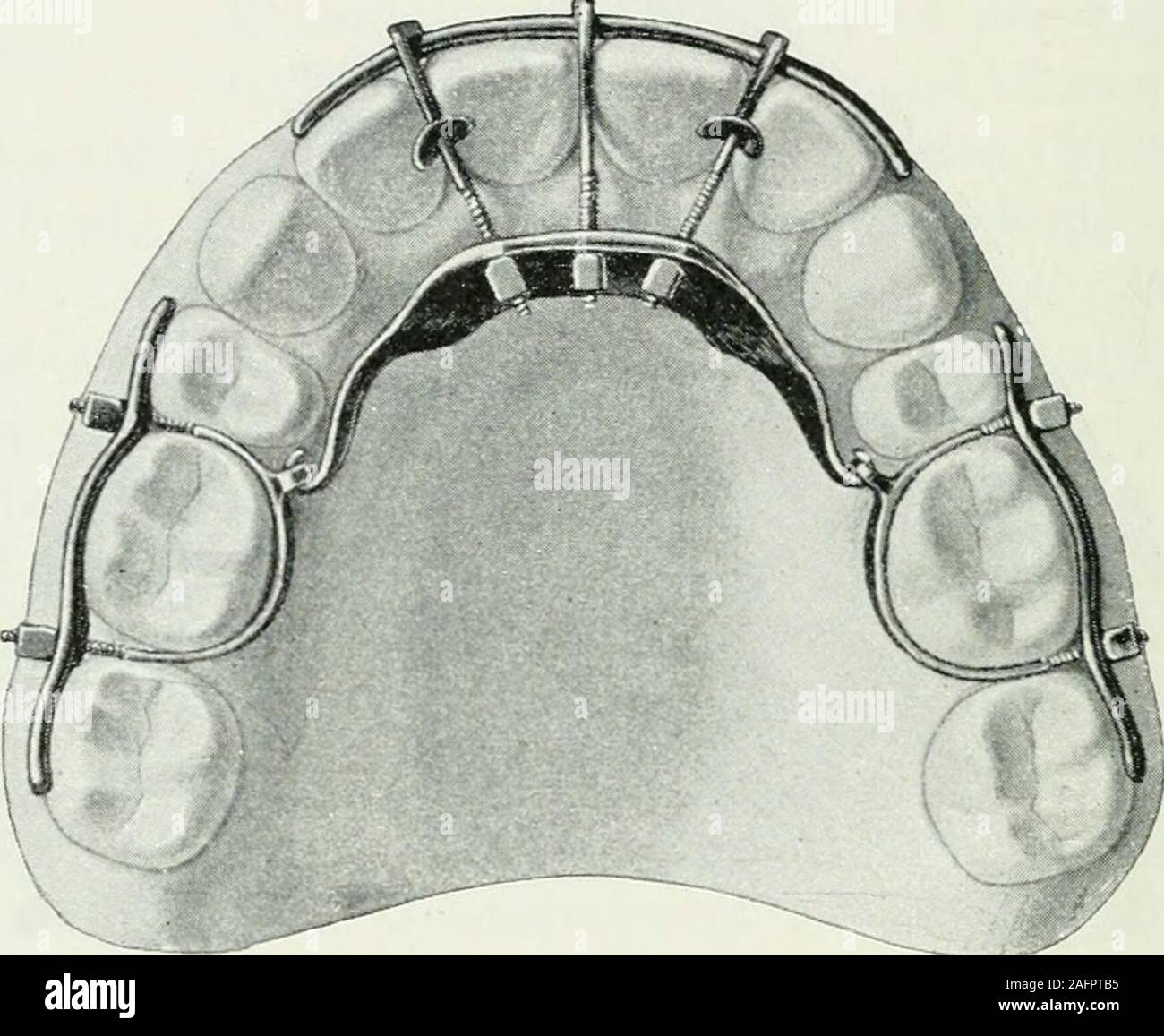 Lehrbuch der orthodontie fur studierende und zahnartze enschluss mit der  Geschichte der orthodontie. achteileiner diesen l'ihm klar auf der part  liegt. Retinierter Nurda- Hervorziehen Zähne, auf das später noch werden  soll