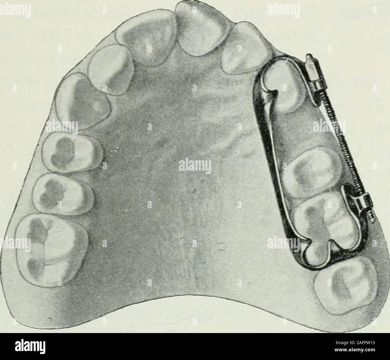 . Lehrbuch der orthodontie fur studierende und zahnartze enschluss mit der Geschichte der orthodontie. rhältnisse des Patienten. Auszuziehen Welche Zähne sind, ist nach Farrar oft zu entscheiden, sehrschwer Extraktion die unteren und Schneide-zahnes befürwortet er en saurait manchen. Dagegen perhorre sziert-er die oberen Schneide eines Extraktion gleichnamigen-zahnes, da der Verlust von der oberen Frontzähne eineEntstellung. weisheit stets Er nur einen Eckzahn s extrahiertsehen, wenn die dem gesellschaftszweck Bikuspis daneben forme einesEckzahnes gegeben werden kann. Für die Entfernung vonBikuspi Banque D'Images