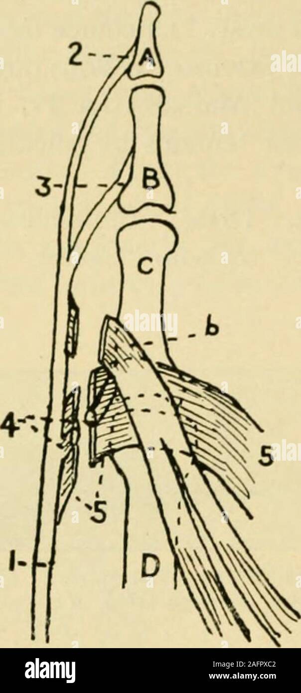 . Manuel de chirurgie opératoire. tion d'hyper-extension tandis que les deux distalphalanges devenir en flexion. La déformation est bien sûr la plus marquée dans la bagueet le majeur. Si la lésion au nerf ulnaire est très haut, puis le innerhalf du flexor digitorum profundus est aussi impliqué et pas de griffer de thefingers est produite. Les tendons extenseurs des doigts du col du poignet au-dessus de la Tête du métacarpien os, et chacun envoie un bordereau d'insertion pour les bases de la première, deuxième et troisième phalanges respectivement. Au niveau de l'metacarpo--phalangienne, une expansion fibreuse passe fr Banque D'Images