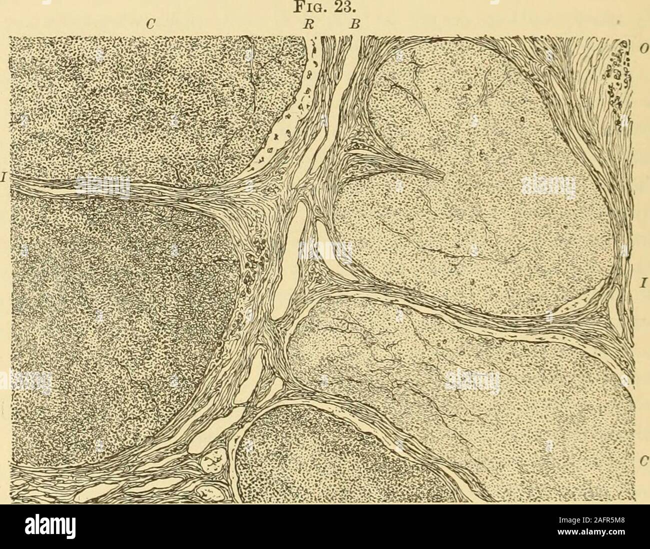 . Gyncology clinique, soins médicaux et chirurgicaux. Angioma caverneux de l'utérus, la moitié de la taille. 584 néoplasmes bénins de l'utérus. Le sang n'est pas uniformément répartis dans les veines, dont certains ont montré composé principalement de caillots de sang rouge-globules et compara-ment de la fibrine ; peu d'autres cavités, au contraire, a tenu une bonne partie de fibrinand le sérum, mais pas beaucoup de globules rouges. Cette étrange fait beaccounted peut par la circonstance que le sang n'a pas entrer tous les varices la tumeur, un certain nombre de veines d'être partiellement ou complètement effacées,et par conséquent présenter un obsta Banque D'Images