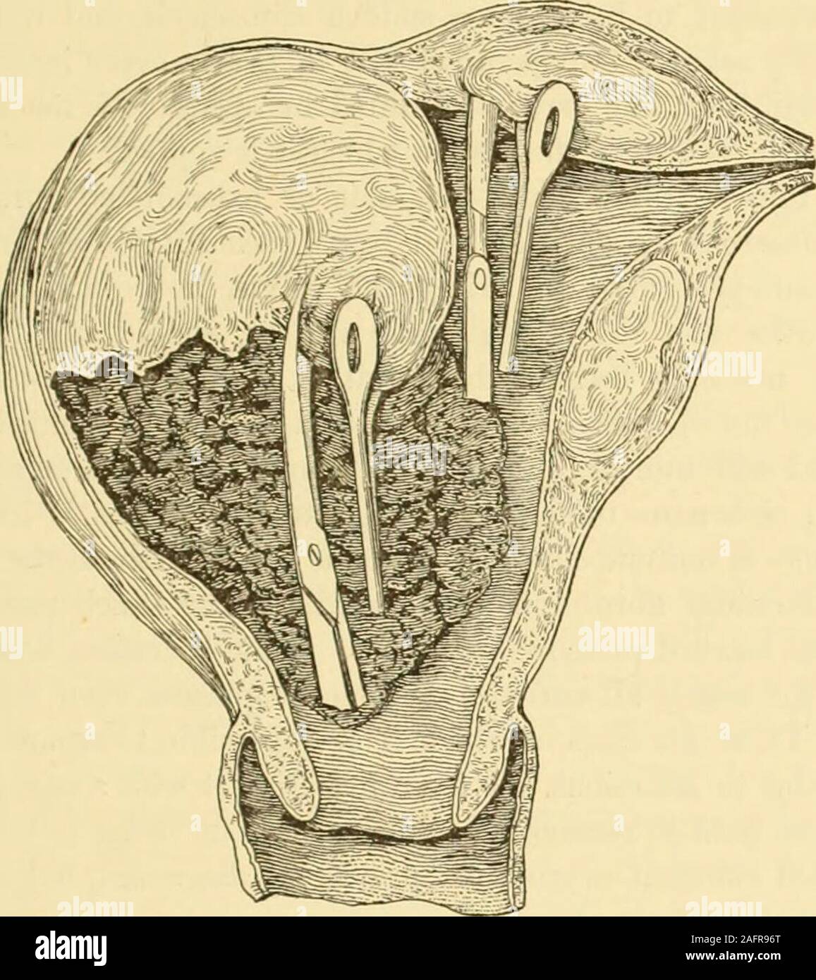 . Gyncology clinique, soins médicaux et chirurgicaux. Bullet forceps. et la lèvre postérieure de l'utérus. La tumeur est examinée avec l'fingerto déterminer ses relations avec l'utérus, puis une incision est faite de néoplasmes BEMGX L'UTÉRUS. 571 directement dans la croissance, qui a été saisi par un fort volsella anddrawn ; la baisse de force un morceau est donc découper avec des ciseaux ou un couteau.De cette manière, le processus se poursuit jusqu'à l'ensemble de la croissance est re-déplacé, les forceps Museux remplacés parfois par dentated-pour-ceps kyste ou par le forceps de dentelées Pean. Les gros morceaux de la tumeur peut Banque D'Images