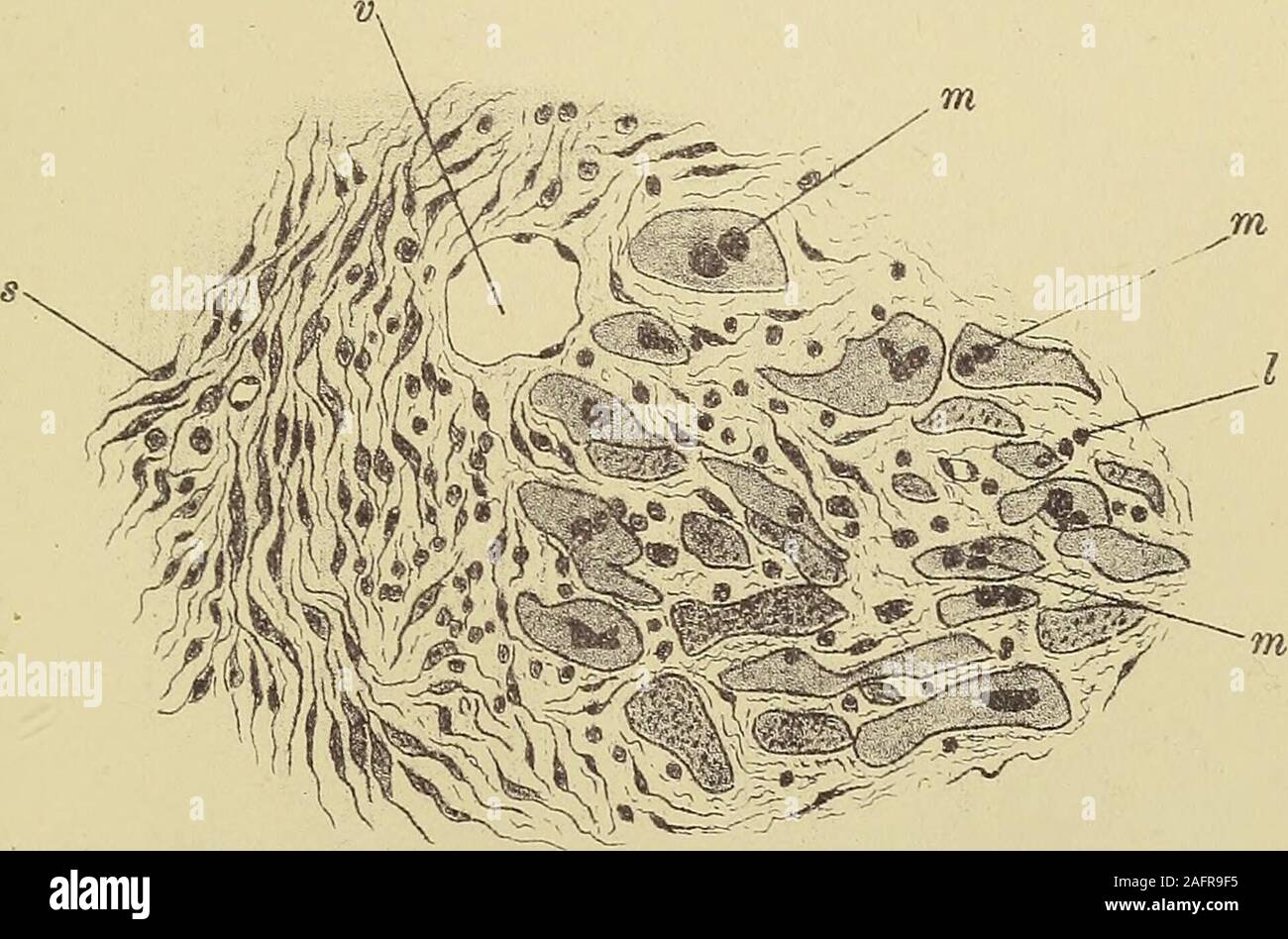 . Les maladies du coeur et l'aorte thoracique. Fig. 153.-une partie de l'spindk couche unicellulaire de la section représentée à la fig. 149, plus fortement grossie (environ 250 diamètres). une fusée, cellule ; h, capillaires navire ; c, déleucocyté.. Fi&. 154.-une partie de la préparation en shotni fig. 149, à la jonction du myocarde andspindle couche unicellulaire, magnifié aboid diamètres ne beticeen ; montrant les leucocytes le viuscularfibers 1 Prolifération des noyaux des fibres musculaT et disparition de leur fibriUie. - S, des cellules fusiformes ; y, divisé transversalement navire ; m, vi, la prolifération des noyaux Banque D'Images