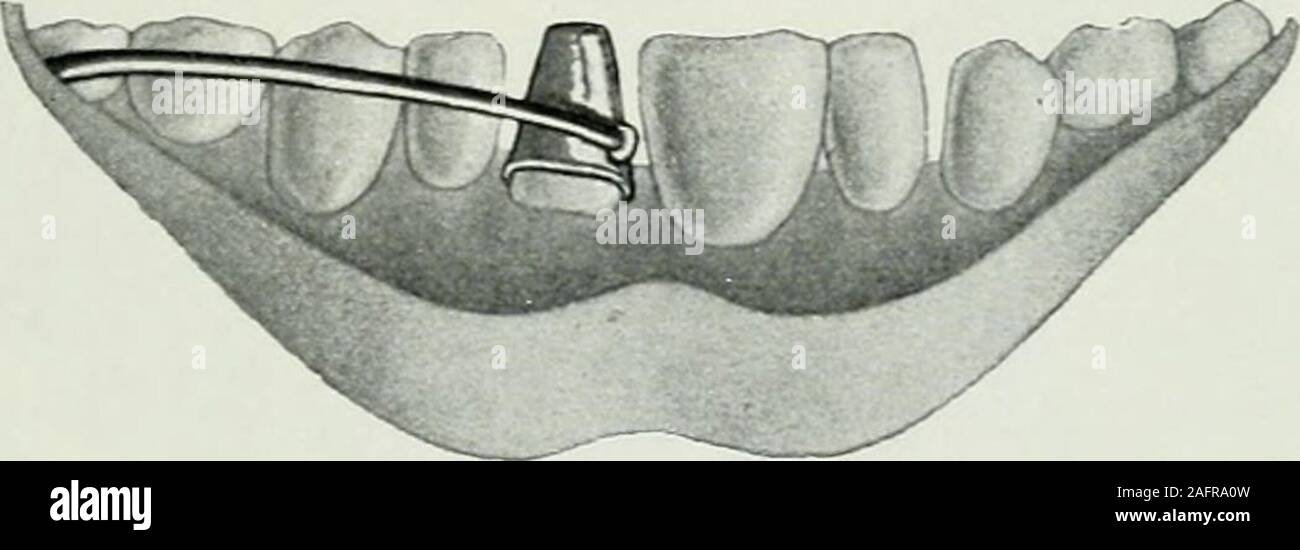 . Lehrbuch der orthodontie fur studierende und zahnartze enschluss mit der Geschichte der orthodontie. r eine der Extraktion Milchzähne, wie z. B. beim durch-brechen des Ersatzzahnes Milchgebisse hinter dem Vorgänger im.Bei zu engen Kiefern empfahl er, die schiefen Zähne und mit Holz-Seidenfäden keilen, die er zwischen die Zähne einlegte oderfestband, gerade zu richten. Er sich fest. feinenunregelmäßigen auszuziehen,Zahn, die er drängte Nachbar-zähne vermittelst kleiner Holzkeile dans die Lücke. Bei Achsen-drehung riet er, eine Art Hut oder kleiner Metallkapsel (Fig..306) anzuwen Banque D'Images