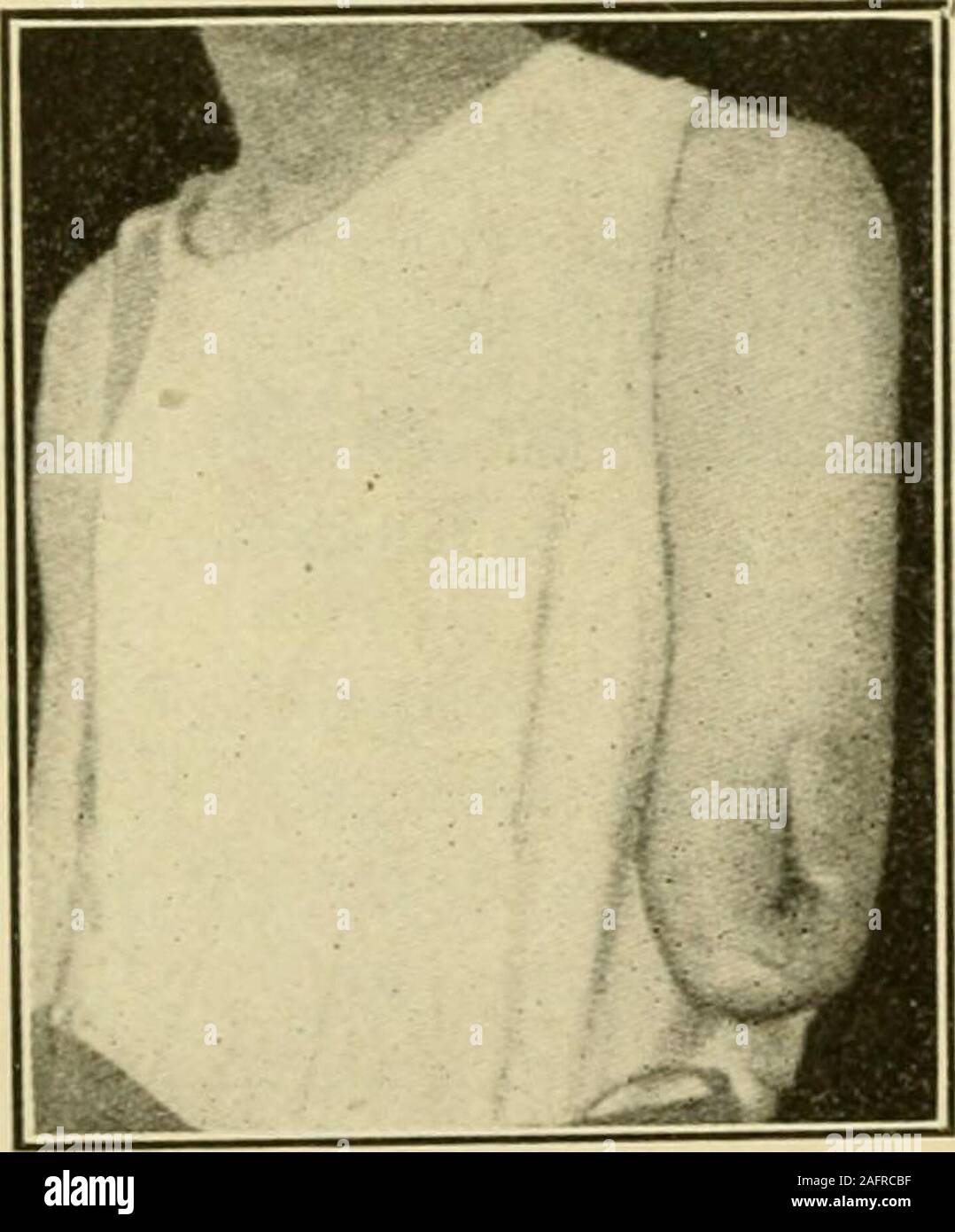 . Manuel de chirurgie opératoire. f le fléchisseur profond ne sont pas divisé, mais probablement leur division en dessous de leur union avec le flexor sublimis wouldgive une plus grande mobilité. Ashhurst (Annales Surg., déc., 1914) opère sur thearm comme suit : l'Étape I.-reflètent un lambeau cutané longitudinal tant que le diamètre de l'limband environ un pouce de large, avec sa base à la ligne proposée de l'article de thebone. Ligaturer et diviser les navires brachiale juste au-dessus de l'emplacement d'bonesection. Diviser les nerfs au même niveau ou plus haut, fig. 1443. L'étape 2.-Faites une incision longitudinale sur la face externe du bras entre Banque D'Images