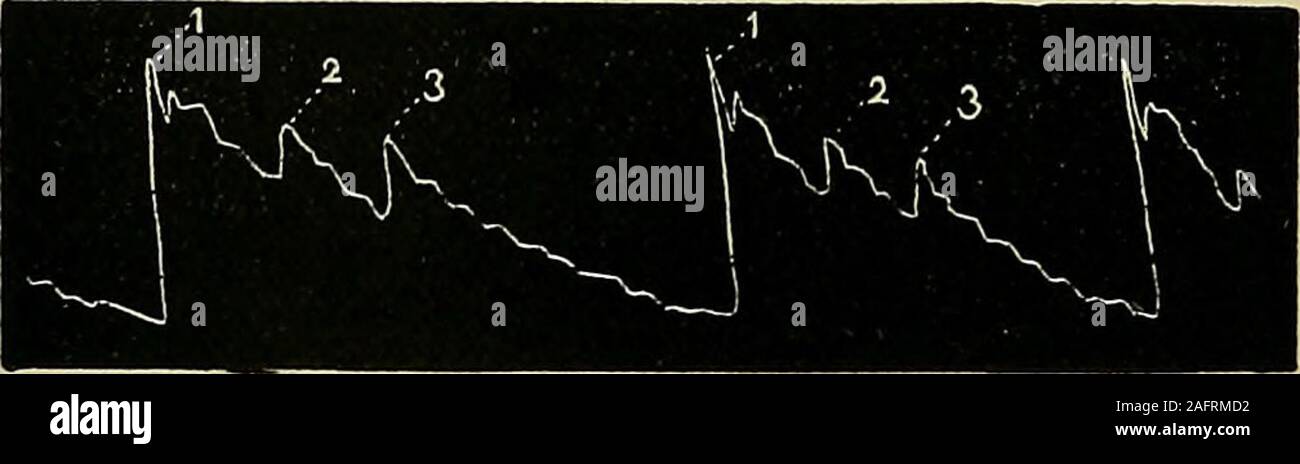 . Les maladies du coeur et l'aorte thoracique. Fig. no-Pulsus. bisreiiiijiiis. Fig. 111.-trizeniinnts Pulsus. Irrégularité dans w///w^. -Irrégularités dans le volume (seefig. 112) dépendent du fait que les quantités inégales ofblood sont déversées dans le système artériel à differentcontractions du ventricule gauche. La condition est usuallyassociated avec irrégularité dans le temps, pour quand le timebetween les contractions ventriculaires varie, le montant de l'irrégularité de l'impulsion. 271 le sang qui le ventricule gauche doit se décharge trop tovary apt. Banque D'Images