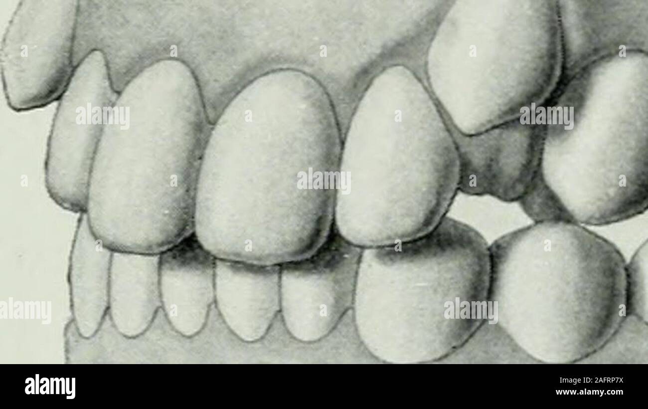 . Lehrbuch der orthodontie fur studierende und zahnartze enschluss mit der Geschichte der orthodontie s Gebissesund. ,,la force de redressement, unwidersprochen bleibendürfen die nicht. Legen wir uns jetzt die Frage vor : woher kommt es, daßdurch nichtstattfindet zufriedenstellende eine Extraktion Selbstregulierung, wie die Fälle Kunertschen zur Evidenz zeigen ? DurchExtraktion praegarten Raum geschaffen werden. Cette wirdzum Absicht Teil illusorisch gemacht, dass sich das effet Gebiß und 3. Mélange Behandlung von Hauptklassen Anomalien einzelner. Alveolarfortsatz 245 damit der nach jeder Extraktion verk Banque D'Images