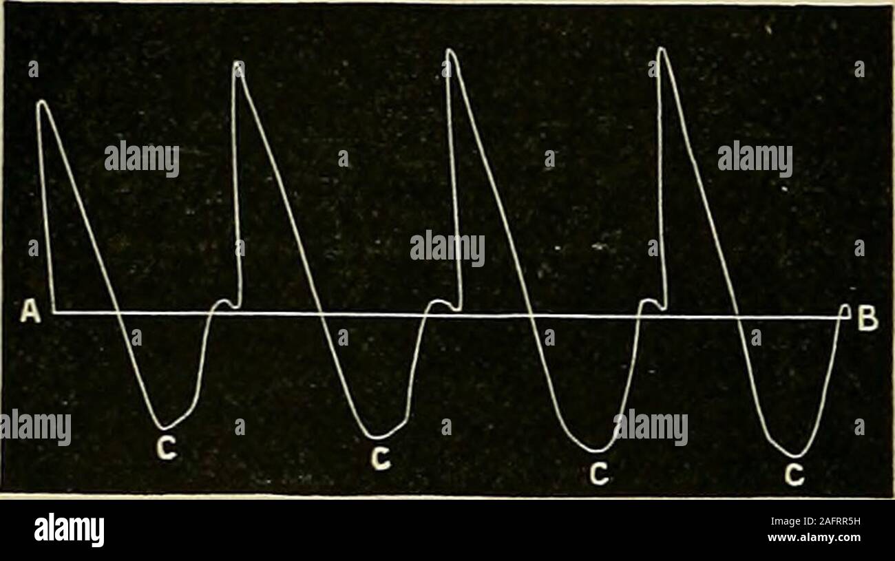. Les maladies du coeur et l'aorte thoracique. se est appelé/////y dicrotic.Dans cette condition l'artère n'est apparemment pas plus distendedat la fin de la systole ventriculaire qu'il est à son début, et com-c'est distendu apparemment moins qu'il isduring^ la diastole ventriculaire (voir fig. 91), si) lorsque l'encoche aortique C coule au-dessous du niveau de la Ce n'est pas bien sûr dire que le système artériel, comme wliole moreempty est, à la fin de la systole ventriculaire que c'est pendant l'ventriculardiastole, mais simplement que le bateau au point où l'observation est prise apparemment,p Banque D'Images
