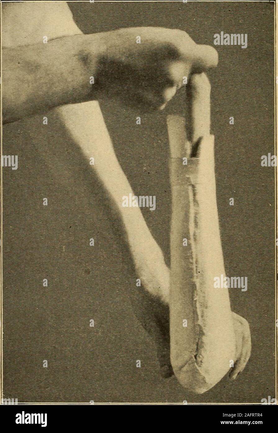 . Un traité pratique sur les fractures et luxations. angu-déplacement lar et dominante, et ce qu'il s'agit d'theattitude pronation ou supination semble être indifférent. L'objec-tion à l'attitude de la supination est sa plus grande contrainte et incohérences-venience ; si l'attitude est souhaitable l'inconfort peut être évitée en JMedioal ^ Lonsdale : Loudon (lazotto, 18o2, vol, ix. p. 910,20 306 fractures. l'alitement ^Yith enlevés le bras et le coude plié à angle compris, dans Avhich la position repose avant-bras en supination complète facilement.Une méthode commune de traitement est de Banque D'Images