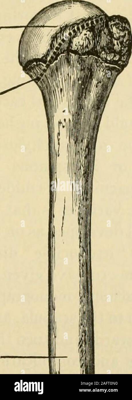 . Manuel de chirurgie opératoire. et les nerfs. L'opération est essentiellement le même que forreduction de la dislocation, mais le chef de l'os est supprimé après la section du cou à l'aide d'un fil Gigli a vu. Assez d'os doit être retiré pour insurea bonne nouvelle articulation. En tant qu'aide à l'élaboration d'un nouveau projet conjoint peut couvrir une thedivided de l'humérus avec le rabat de muscle ou, mieux, du fascia et fat.En ce qui concerne l'excision, Jonas a écrit : c'est une opération qui doit être évitée, whenpossible sur compte de l'état de fléau du bras et pourtant doitêtre fait (a) lorsque la tête humérale et ne Banque D'Images