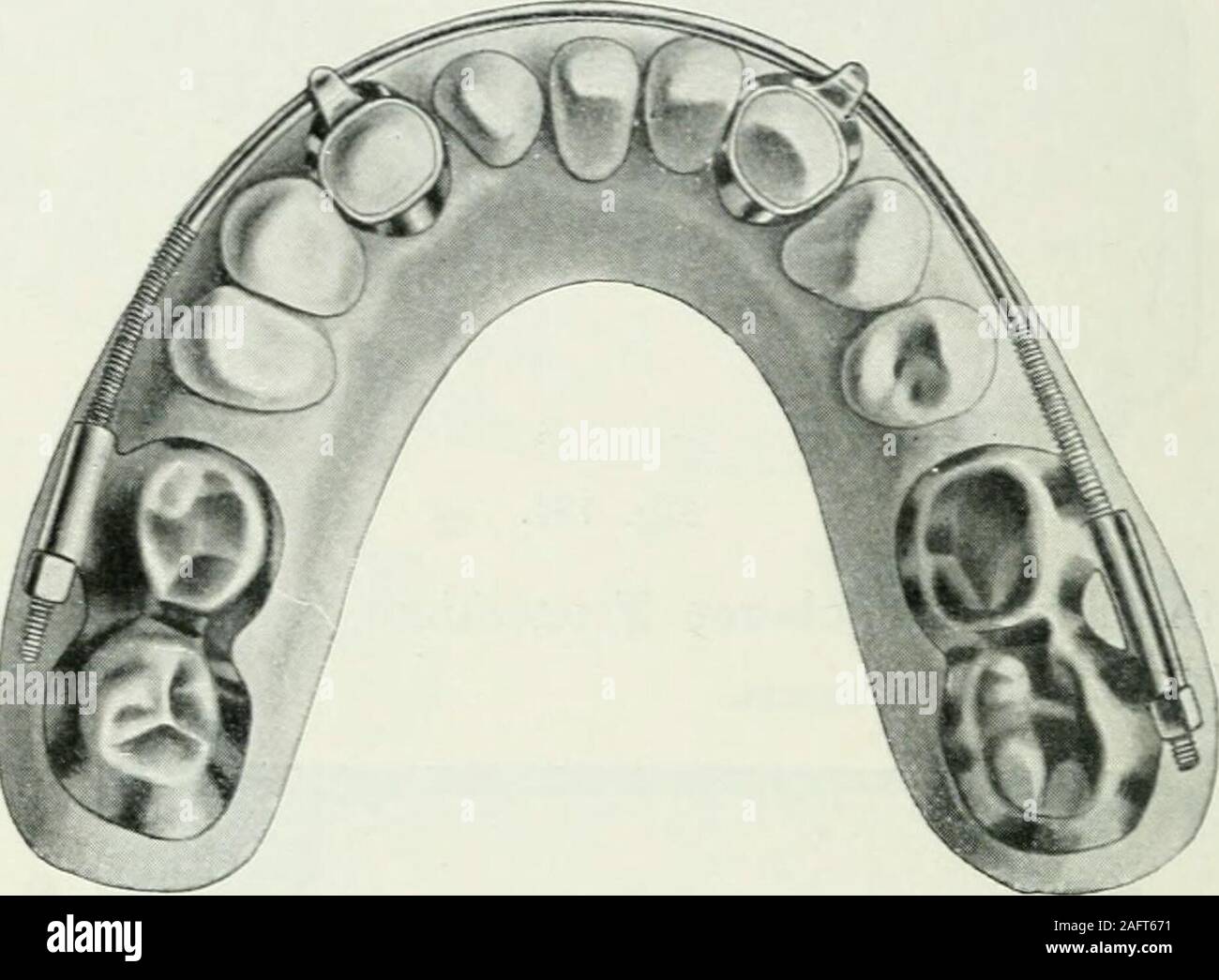 . Lehrbuch der orthodontie fur studierende und zahnartze enschluss mit der Geschichte der orthodontie. Figr. 1S5. Fig. 184 zeigt den Erfolg der Behandlung. Aus der Abbildunggeht unzweideutig hervor, dass die Extraktion des linken Prä- 208 11. Therapie der Anomalien. molaren eisern ein Fehler la guerre. Im Übrigen beide weisen Zahn-bögen symmetrische auf die Formen. Artikulation stimmt genau.Automne Fig. 185 stellt eine totale Progenie vor der Behandlungdar. Hier ich mit bedeutenden. Schwierigkeiten zu kämp-fen, da die betreffende Patientin ihr die Lebens dreißigstes überschr-jahr bedeutend Banque D'Images