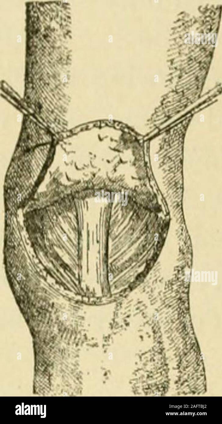 . Manuel de chirurgie opératoire. e est muchpain et d'invalidité, si le traitement conservateur n'a pas réussi à donner du relief, ar-throtomy est indiqué pour l'exploration, d'être suivie par une forme d'atyp-résection ical d'après les lésions dépistées. La luxation congénitale de la genou.-^Hiibschers Hiibscher.-(von Salis, Deutsche Zeitschrift für Chir., cxiv, 148) exploité en cas de luxation antérieure du tibia sur le fémur dans une fille de quatorze mois à compter de l'âge.La patella était absent. Réduction manuelle est impossible. Wasreflected la peau dans un rabat sur l'avant du genou (Fig. 1293). Les dix Banque D'Images