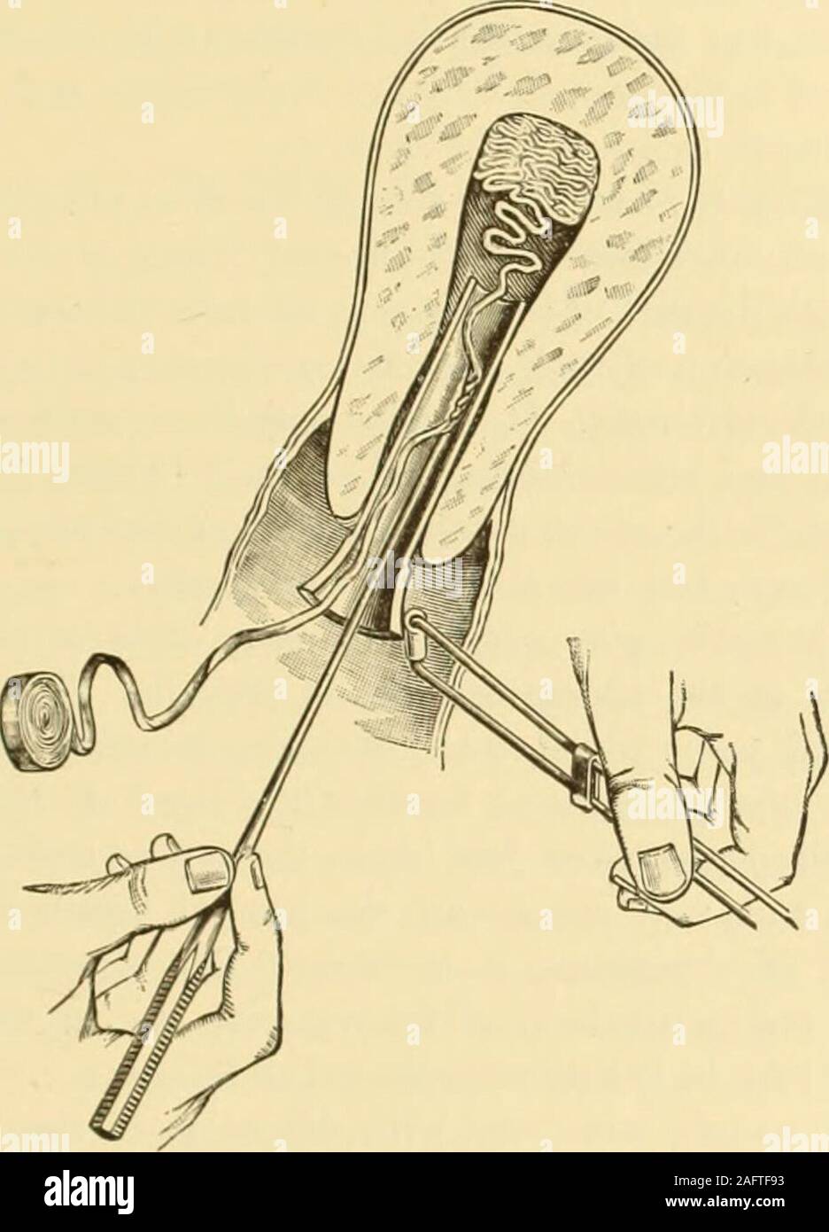 Curetage Uterin Banque D Image Et Photos Alamy