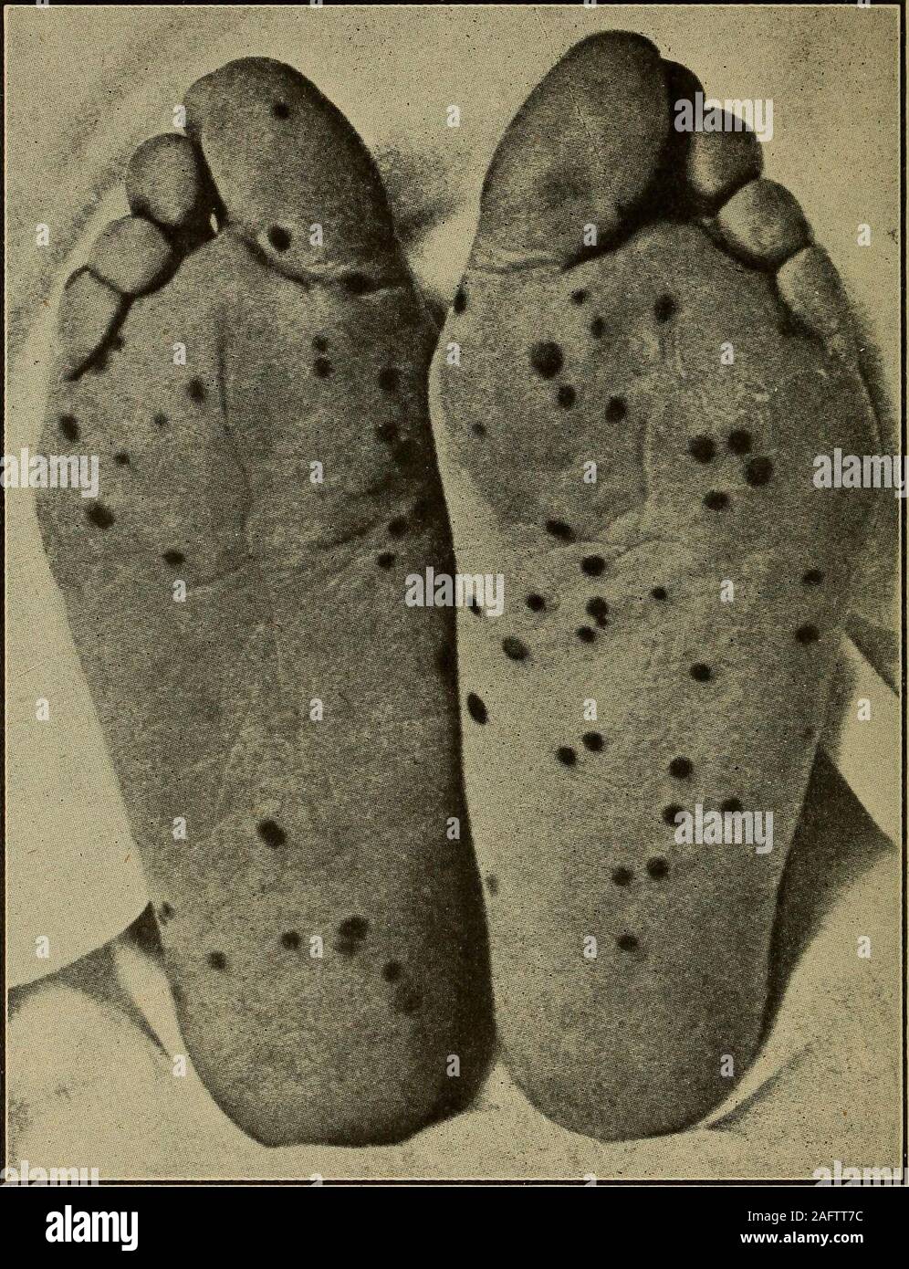 . Diagnostic médical pour l'étudiant et praticien. ment, et la structure de la pustule où trouvés est généralement typique. Complications.-Ces sont facilement déduire de ses symptômes et le chemin-ologie de la maladie, étant principalement liées à la suppuration et pro- des symptômes bénins. 1098 DIAGNOSTIC MÉDICAL En unvac-greatmortality, vaccinés. Dans vaccinés,négligeable. Type de maladie de l'âge. andphysique,trouvé la toxémie. Il suffit de les nommer comme suit : l'oedème glottidis, necro-sis des cartilages, la broncho-pneumonie (initial), parfois de pneumonie lobaire(rare), pleurésie (pas rare), pseudo-angine, diarrhée Banque D'Images