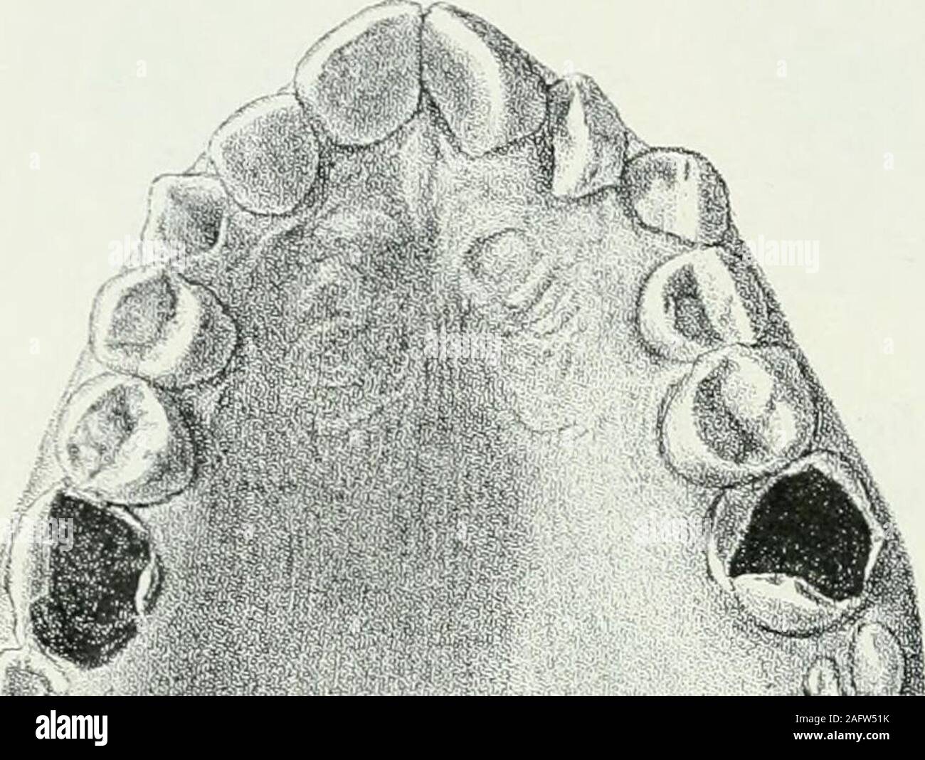 . Lehrbuch der orthodontie fur studierende und zahnartze enschluss mit der Geschichte der orthodontie. Fig. 79. bögen zueinander nicht zu stören und eine Richtigstellung dans derFrontzähne beiden Kiefern s'zu. Sodann Sternfeld schreibt über einen zweiten Automne :"Fig. 39, 40 (76, 77) zwölfjähriges Mädchen. Sämtliche Zähnedichtgedrängt Oberkiefer stehend, besonders im, wo die zähne für Eck-nicht im entferntesten genügend Raum vorhanden ist. 124 I. Prophylaktische Maßregeln. Extraktion der vier sechsjährigen Molaren, die zwar zeitig ge-füllt waren, nach einigen Jahren aber sekundärer Karies Banque D'Images