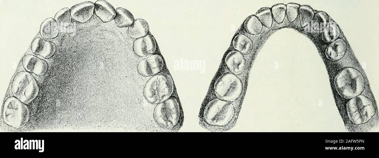 . Lehrbuch der orthodontie fur studierende und zahnartze enschluss mit der Geschichte der orthodontie. Fig. 7 : Fig. 73. um die Hälfte verringert rapide. Der appartements völligen rapide Ver-streichung der Lücken fällt auf den une exploitation Abbildungen:die Entwicklung der ausgezeichnete Weisheitszähne diewesentliche und Verbesserung der Stellung der unteren zahne avant.. Fig. Fig. 75. Beides sicher ist nur durch die Extraktion der sechsjährigenMolaren erreicht. Hier ist die Extraktion nichtsgerechtfertigt Molaren durch der ersten, da die nur kariös letzteren unbedeutend sind. Wenn einmal extrahiert werden Banque D'Images