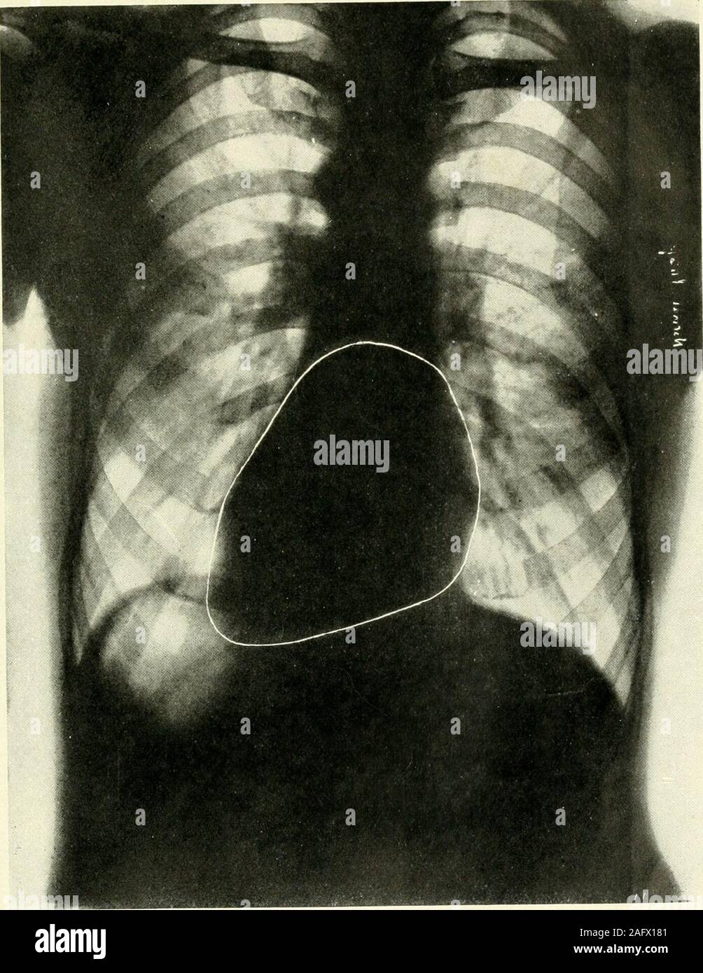 . Le journal américain de l'anatomie. ave été arbitrairement terminée, sont également indiquées par des lignes d'encre blanche.La silhouette est 127,5 cm2. Réduction de 6  % donne une surface nette de 119.9cm2. Le diamètre transversal est de 12,5 mm. Réduction de 3  % donne 12.1mm. En tant que net diamètre transversal. La comparaison des mesures de l'thisheart avec la norme sont comme suit : TRANS- Poids Taille .4GE-VERSEDIAME TER SALON livres Volume m2 un. CC. Observé. 146.3146.3 5 llf55 4343 12.113.0 119.9120.5 pour Standard Standard 700 de poids pour la taille et l'âge 179,05 ll-i 43 13,9 138,0 860 Standar Banque D'Images