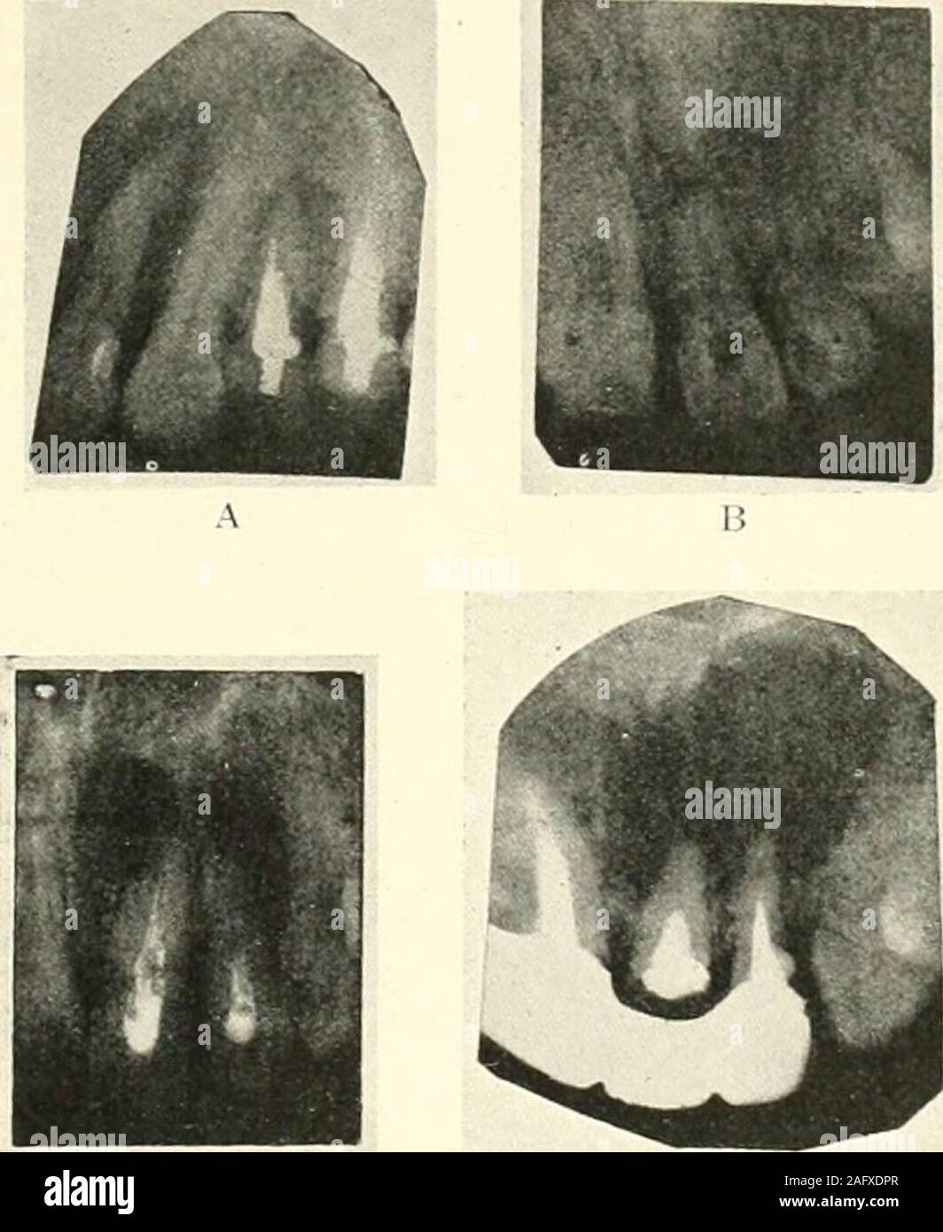 . La science et la pratique de la chirurgie dentaire. Fig. ySO.-Liistal Caries dans tii-st pierre-withpulp molaire inférieure à la fin de matière coronale racine antérieure. dire d'une torsion de l'questionof centrale d'un apex est d'une importance vitale. Dans le cas de dents où la pulpe. Fig. 951. 1) A. L'absorption de l'apex de la première prémolaire supérieure, couronné et raréfaction de l'alvéole. B. après absorption apicale de réimplantation l'incisive centrale supérieure gauche. C. Des abcès de gauche supérieure et centrale incisives latérales. Certains l'absorption de l'apex du latéral gauche.1). Le kyste dentaire : gauche supérieure et latérale centrale api incisorswith Banque D'Images