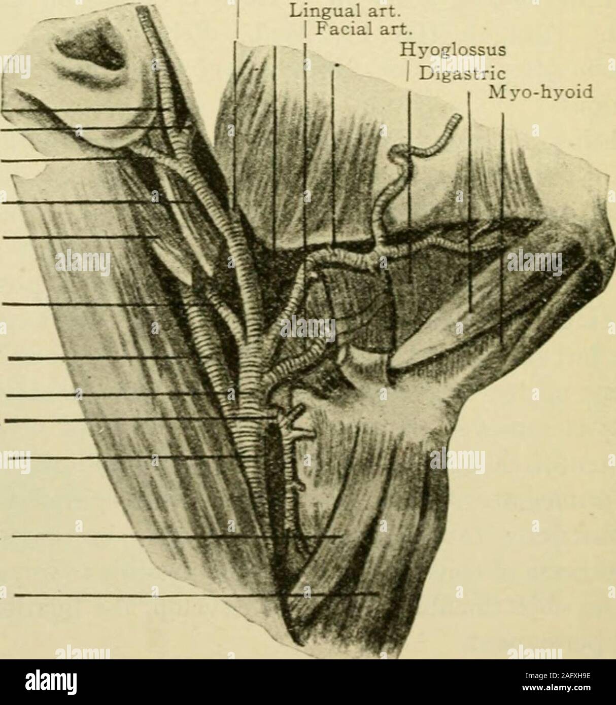 . Manuel de chirurgie opératoire. Pour thispurpose Fowler a jeté une bande autour du navire, la sécurisation de la bande par forceps,tandis que Crile utilise avec succès sa pince spéciale. La ligature des trompes VEINE JUGULAIRE INTERNE de la veine peut être nécessaire en cas d'opération sinus sigmoïde thrombosisThe est pratiquement la même que pour la ligature de la carotide. Particularcare doit être exercé en passant la ligature autour de la veine, comme ses murs minces arevery et sa taille varie considérablement au cours d'une expiration et d'inspiration. La ligature de l'artère carotide externe.AL Position du patient comme dans la ligature de la voiture commune Banque D'Images . Manuel de chirurgie opératoire. Pour thispurpose Fowler a jeté une bande autour du navire, la sécurisation de la bande par forceps,tandis que Crile utilise avec succès sa pince spéciale. La ligature des trompes VEINE JUGULAIRE INTERNE de la veine peut être nécessaire en cas d'opération sinus sigmoïde thrombosisThe est pratiquement la même que pour la ligature de la carotide. Particularcare doit être exercé en passant la ligature autour de la veine, comme ses murs minces arevery et sa taille varie considérablement au cours d'une expiration et d'inspiration. La ligature de l'artère carotide externe.AL Position du patient comme dans la ligature de la voiture commune Banque D'Images
