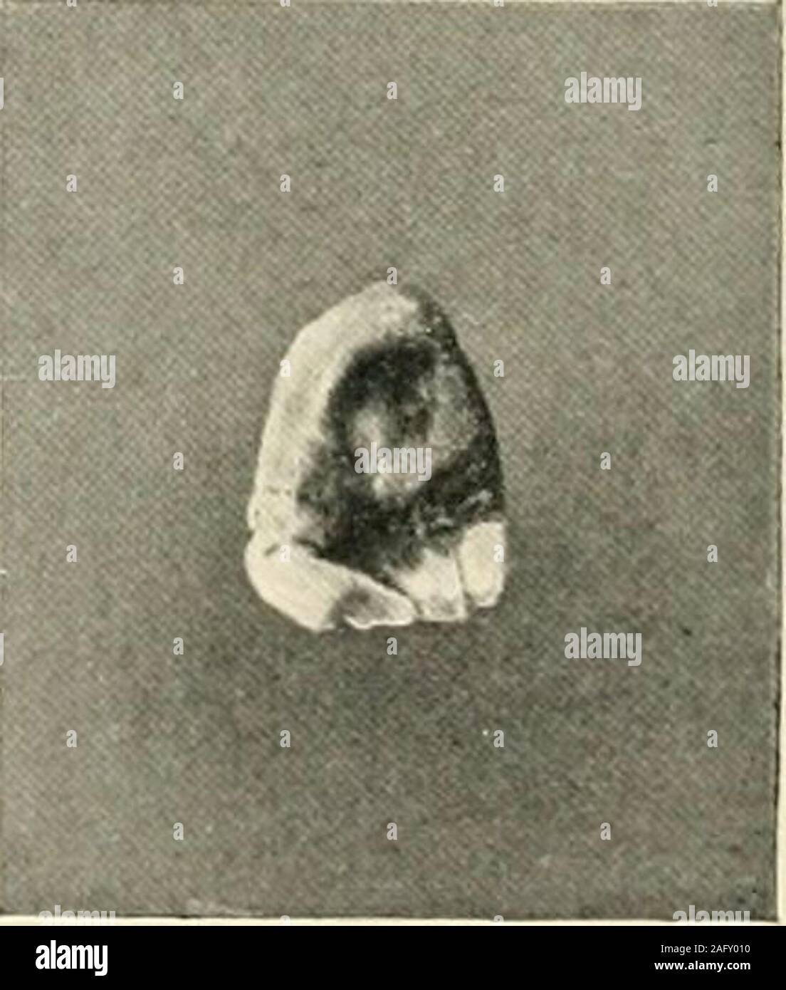 . La science et la pratique de la chirurgie dentaire. Fig. 902. (2) des anomalies de l'os ou l'articulation.-La plus commune est l'excès de con-consolidation d'un thickstrong morefrequently alvéole, rencontré à l'intérieur des dents isolées ont perdu leur thathave hennis-bours. Cette afirmly toothdefy devrait implanter l'effort d'extraction,il est bien de s'abstenir, il andtry encore une fois dans une journée, quand loosenedby ortwo, la parodontite, il peut être retiré facilement withcomparative themaxilla de néoplasmes.mandiblemay ou donner lieu à difficulté;l'administration d'un. Fig. 903. demandanesthetic trismus peut et la force de l'opeiiing 657 Banque D'Images