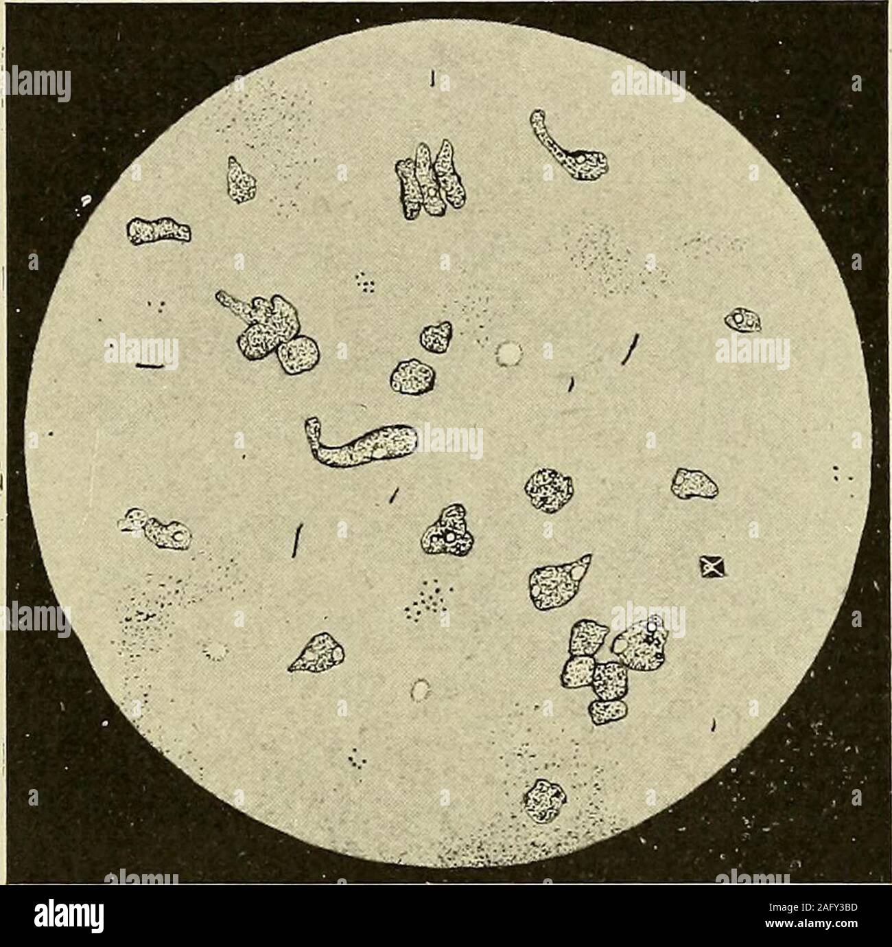 . Les maladies du rectum et anus : conçu pour les étudiants et les praticiens de la médecine. ccumulate, gâteau, et agir comme un irritant. Quand rectitis aiguë en raison d'threadworms relievedby bientôt quelques injections d'eau salée en collaboration avec santonininternally. Inflammation aiguë sera occasionnellement devenir chronique en dépit de tout traitement. La proctite chronique proctite chronique est une longue con-dition inflammatoire de la muqueuse rectale qui parfois s'étend aux tissus. theunderlying C'est rencontré plus fréquemment chez l'adulte la rectite 211 que chez les enfants, et les femmes en souffrent plus souvent e Banque D'Images