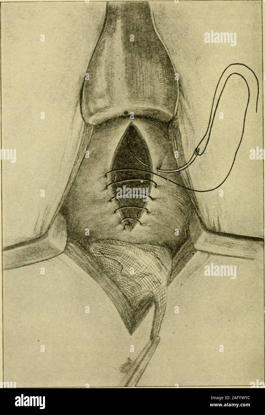 . Manuel de chirurgie opératoire. eans de cautérisation couteau. N'essayez pas de détruire la croissance avec la cautérisation, il butlift avec pinces et disséquer l'écart, à l'aide de la cautérisation comme un couteau. 4. Fermer la plaie dans la vessie par l'intermédiaire-et-par stitchesintroduced dans le catgut Connel fashion (Fig. 847). Mettre dans une deuxième couche de points(chanvre) dans le continu ou Lembert fashion jaillissante. À l'extrémité inférieure de la coupe, où la vessie n'est pas couvert par le péritoine, il est facile de si loosenthe péritoine pariétal en continuité avec le péritoine vésical bemade qu'il peut pour se coucher sur la vessie et pe Banque D'Images