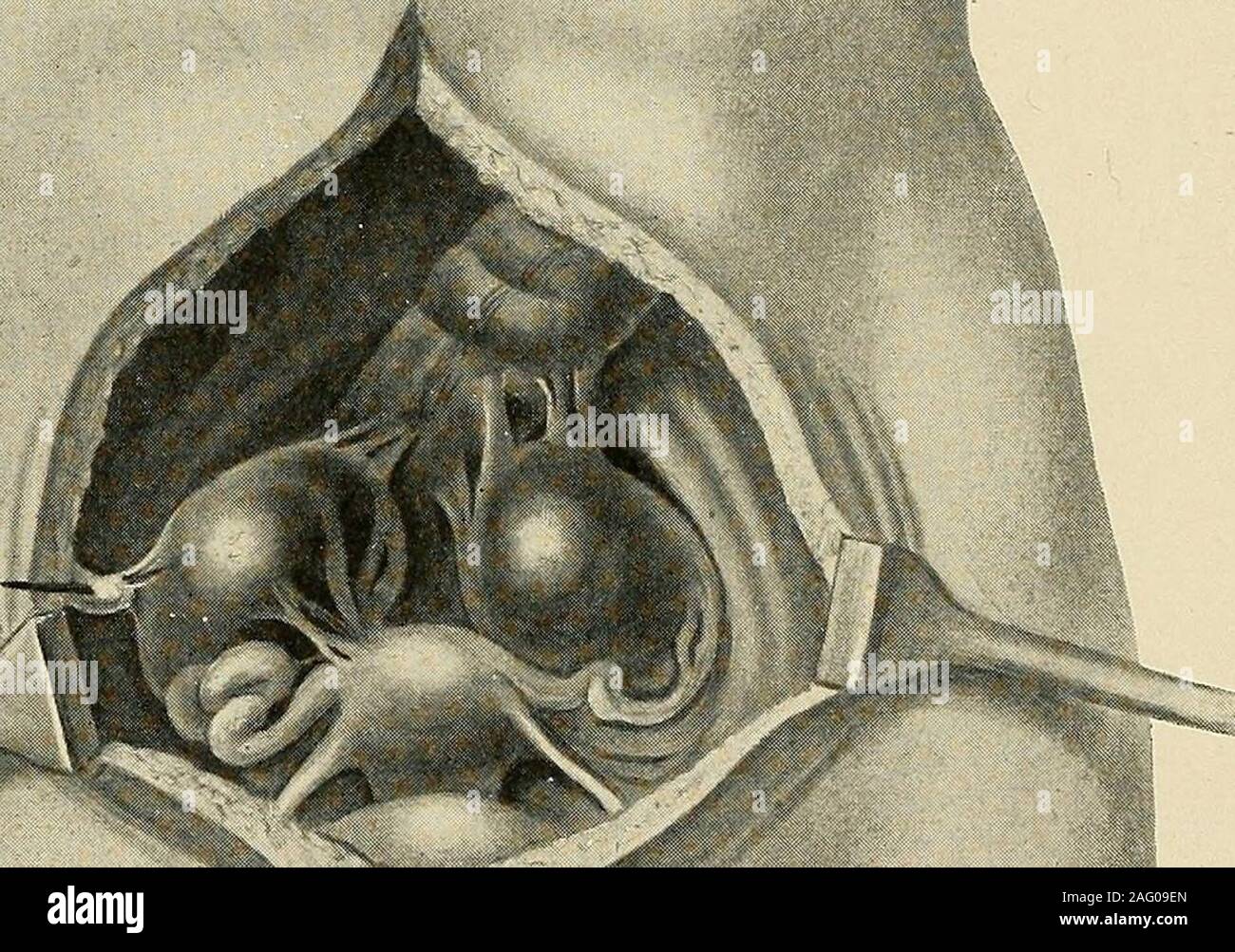 . Le diagnostic et le traitement des maladies des femmes. o pour être oublié, ce qui a donné lieu à une erreur de diagnostic. Le distin-signes de distinguer une tumeur de la paroi abdominale sont donnés dans la première partie de l'thischapter (page 121). 23. Masse inflammatoire de la paroi abdominale. Cela représente à peu près la même signsas une tumeur de la paroi, avec preuves d'inflammation ajouté. 24. Tumeur de ligament rond. Elle se produit au cours de l'roundligament, soit dans la cavité pelvienne ou dans le canal inguinal. Si grande, elle necessarilyproduces grande distorsion de la pièces. Il peut causer beaucoup de confusion dans le diagnostic Banque D'Images