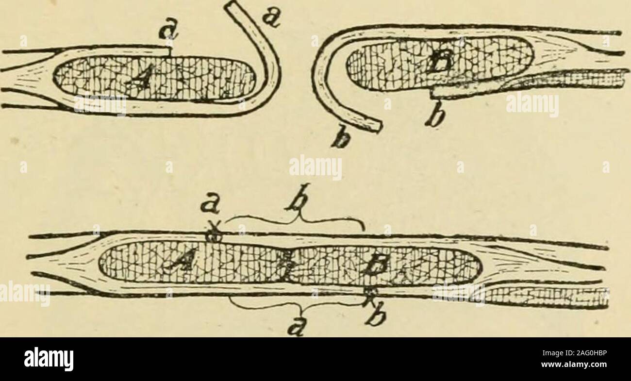 . Manuel de chirurgie opératoire. FiG. 765.-WuUsteins. Hernie ventrale pour tentes comme décrit à l'étape 3 de l'opération classique (page 617). Retirer la graisse et theskin compris entre la première incision. Terminer l'opération par la méthode Mayo. Eventration congénitale ou de l'éviscération est une difformité fatale. Thedifficulty en remplaçant les viscères est dû au fait que le infantilepot habituel est absent, le ventre muscles recti passent directement vers le bas du rebord costal à topubis ; les intestins, si distendu par le méconium, n'ayant pas pushedthem avant dans la manière habituelle. Charle Banque D'Images