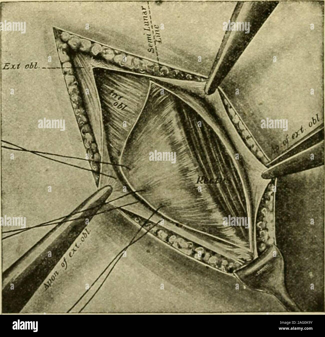 . Manuel de chirurgie opératoire. Fig. 758.-(Halsted.). Fig. 759.-{Halsted.) Kirschner (• Archiv fur klin. Chir., xcii, 896) soutien à la ligne de suture asfollows : Faire une incision à travers la peau de la cuisse et exposer une sufficientarea du fascia lata ; une bande d'accise du fascia lata plus longtemps que la plaie deux andabout herniaire à deux pouces et demi de large ; la diffusion de ce volet de l'aponévrose musculaire au-dessus de la ligne de suture de la fermeture du canal inguinal et il suture là. 615 EVENTRATION INGUINALE dans une hernie inguinale qui avaient rechuté après l'opération par deux excellentsurgeons Kirschners a adopté, l'auteur a rencontré Banque D'Images