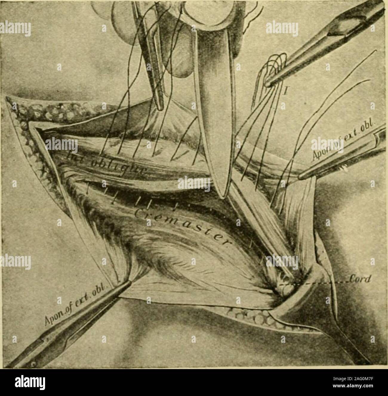 . Manuel de chirurgie opératoire. Fig. 753.-{A. H. Ferguson.) l'extrémité émoussée en premier) est passé entre eux. Ligaturer les veines du bas du à un point aussi haut que possible au-dessus du testicule, le moignon étant,bien sûr, à l'extérieur de l'anneau externe de l'abdomen. Étape 5.-^ligaturer la transfixion par sac ou un sac à main à la suture-highestpossible point. Après avoir fait cette suture ses extrémités courbées sur needlesand les passer l'extérieur sous le muscle oblique interne pour pénétrer dans themuscle à partir de l'extérieur en deux points d'environ 5 mm. (^^ po). Tiethe les ligatures. Cette étape il disloque la ne Banque D'Images