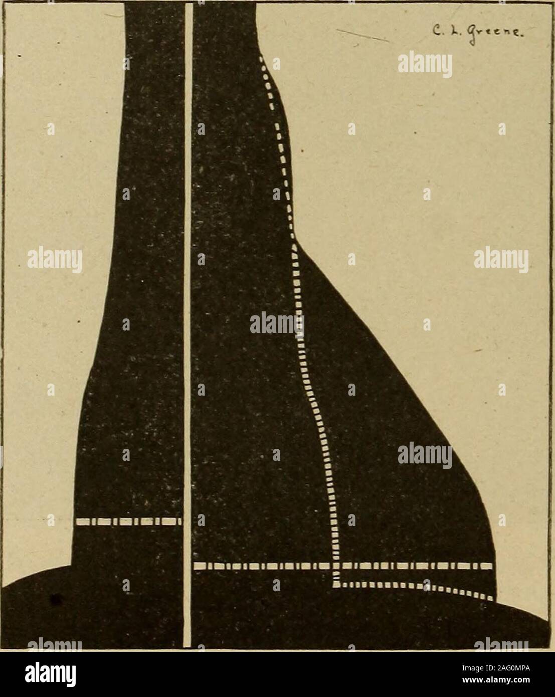 . Diagnostic médical pour l'étudiant et le praticien. Fig. 300.-goutte coeur dilaté. (Contours dessinés à partir de l'original roentgenograms (byE. Brill) et superposés.) des lignes blanches verticales en pointillé indiquent les grandes lignes après le traitement.Cas de reprise prématurée d'activité après une très grave attaque de pneumonie lobaire.Notez que dans le cas de ce patient ambulatoire portant un coeur dilaté décidément le totaltransverse mais mesure est 12 cm. Les mesures d'origine : Monsieur, 4,0 ml, 8,0 ;. ; total, 12 cm. Finale : M. 4,0 ml, 5,3 ; ; total, 9,3 cm.. Fig. 301.-goutte coeur dilaté. (Version originale déterminée par orth Banque D'Images