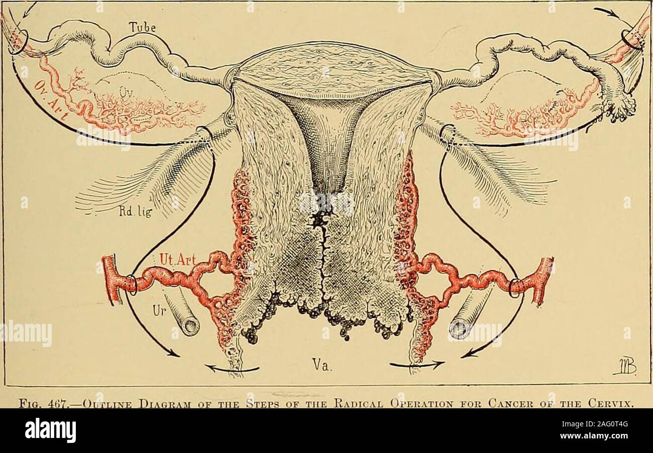 . Gynécologie opératoire. Insérez le bou£ie dans la mesure du possible, comme theposition du point sert à localiser l'uretère. Pour OPEEATIOiq HYSXBRECTOMT ABDOMINALE POUR LE CANCER. 325 en raison de la possibilité d'éléments cancéreuses étant contenues dans les lym-phatics du ligament large supérieur ou dans la série des ligaments. Une telle con-dition est bien illustré m fig. 458. Après l'ouverture du ligament large de cette façon l'incision devrait ensuite becontinued autour d'en face de l'utérus à l'autre ligament rond, sepa-rating le péritoine vésical de son attachement utérin. L'opérateur puis de la même Banque D'Images