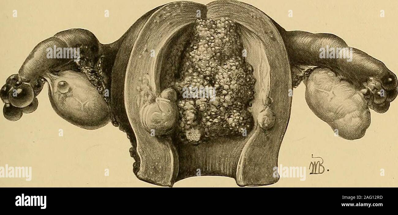 Curetage Uterin Banque D Image Et Photos Alamy