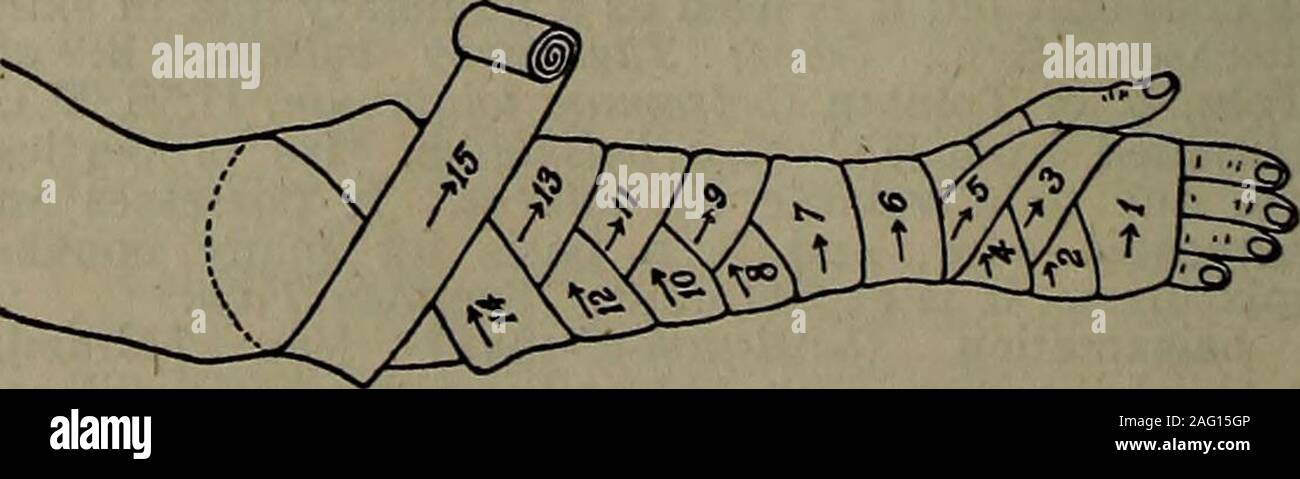 . Le dictionnaire médical du praticien ; contenant tous les mots et expressions généralement utilisées en médecine et dans les sciences connexes, avec leur prononciation correcte, la dérivation, et de définition. Bandage en spirale inversée.. Spica de pied. La figure 8 du membre supérieur. BANDAGES BANDAGES 127 Banque D'Images
