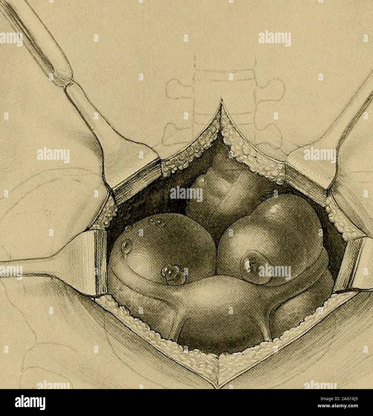 . Gynécologie opératoire. Fig. 444.-Diagramme montrant la manière de combler le déficit laissé par l'énucléation d'un kyste DU LIGAMENT Intra RY par un Sutuee Pelvio Catgut continue de mur pour UterineCornu. 5 janvier, 1894. 300 OVARIOTOMY. Grâce à l'espace clair de manière à inchide les navires qui sont en général groupedat la frontière. Ceux-ci devraient être mis à l'aise à partir de la tumeur, afin d allowplenty de prix pour réduire la tumeur sans les raser de trop près. Theutero-ligament ovarien doit être ligaturé séparément.. KY Folliclf De Graaf, cistes vu in situ. 24 novembre 1H1J4. Dans une jeune femme, c'est Banque D'Images