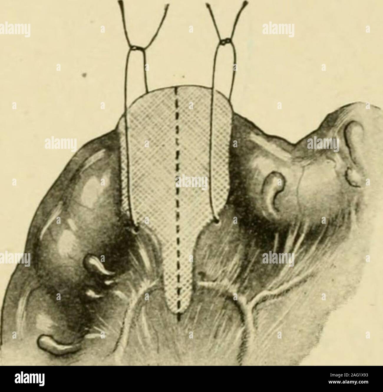 . Manuel de chirurgie opératoire. Il uretère gauche comme il traverse l'artère iliaque commune(Fig. 656). C'est important parce que l'uretère est parallèle et à proximité de vaisseaux mésentériques theinferior et pourrait facilement être ligaturé avec eux. L'artère mésentérique theinferior ligaturer juste au-dessous de l'origine de la première. sigmoidbranch Si la première et la deuxième les artères sigmoïdiennes proviennent d'un tronc commun donot ligaturer le tronc mais le premier lien ci-dessous sigmoïde le tronc et le secondwhen le mésentère est divisé. Diviser le reste de la méso-colon pelvien, des vaisseaux mésentériques inférieurs qu'ils se trouvent dans son pariet Banque D'Images