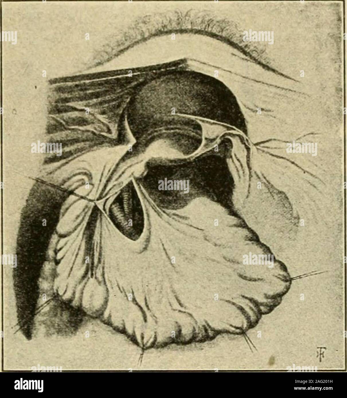 . Manuel de chirurgie opératoire. /I pouces (3 cm.) à partir de la ligne médiane et d'une bagatelle à côté intérieur de l'artère animée, placer le milieu d'une 2 pouces par l'incision du péritoine seul. Par dissection rétracter la lèvre extérieure de la zone péri-toneal plaie et avec elle l'uretère. Exposer la politique et l'externaliliac les artères. Un peu vers le bas et vers l'intérieur exposer le andligate iliaque interne à un point un peu plus d'^^ pouce sous la bifurcation (Fig. 647).Sur le côté gauche la ligature n'est pas aussi facile que sur le droit, parce que le originof la méso-côlon sigmoïde masque les navires. Deux se sont rencontrés Banque D'Images . Manuel de chirurgie opératoire. /I pouces (3 cm.) à partir de la ligne médiane et d'une bagatelle à côté intérieur de l'artère animée, placer le milieu d'une 2 pouces par l'incision du péritoine seul. Par dissection rétracter la lèvre extérieure de la zone péri-toneal plaie et avec elle l'uretère. Exposer la politique et l'externaliliac les artères. Un peu vers le bas et vers l'intérieur exposer le andligate iliaque interne à un point un peu plus d'^^ pouce sous la bifurcation (Fig. 647).Sur le côté gauche la ligature n'est pas aussi facile que sur le droit, parce que le originof la méso-côlon sigmoïde masque les navires. Deux se sont rencontrés Banque D'Images