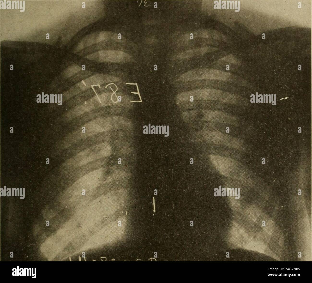 . Diagnostic médical pour l'étudiant et le praticien. Fig. 142.-adhésion après un double pneumonie lobaire. Point d'adhérence indiquée par la flèche. Displaceme nt cf coeur comparaison.j à gauche clearh- illustré. (Voir Fig. 142 pour beaucoup d'épanchements pleuraux sont négligés parce que ce déplacement postural de la ligne supérieure de l'homogénéité est considérée comme un facteur essentiel dans le diagnostic. Et bien sûr la cessation d'une pleurésie.-itscourse la pleurésie en plastique simple s'exécute en quelques jours, laissant derrière eux, normalement, quelques adhésions souvent dis-seulement couvrable post-mortem. Dans les cas d'épanchement séreux avec aspiration des MALADIES DES POUMONS Banque D'Images