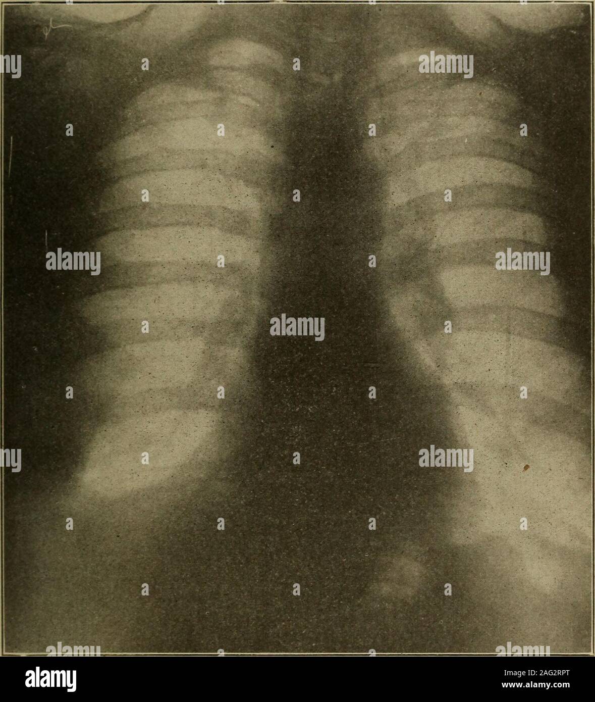épanchement pleural Banque de photographies et d’images à haute ...