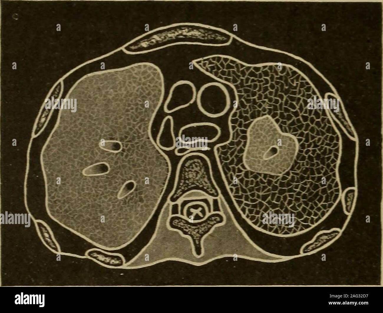 . Diagnostic médical pour l'étudiant et praticien. uperficial lésions. Modification par rapport à la vrai dulness. Les variantes. Misleadinghyper-résonance. Importantpoints. 3oo MKDICAL Apex diagnostic de pneumonie. Hyper-resonancethe nil. Ofemptying effet. connue, le plus souvent les frontières lobaire étant trouvés en arrière et, dans thelarger certain nombre de cas, sur le côté droit. Les lobes supérieurs sont souvent impliqués de façon secondaire ou même principalement, locus thelatter n'étant pas rares dans l'influenza et la confusion tubercu-lous pneumonie lobaire. Si les bronches menant à une zone pulmonaire sont bloqués{sous forme massive) graisse r Banque D'Images