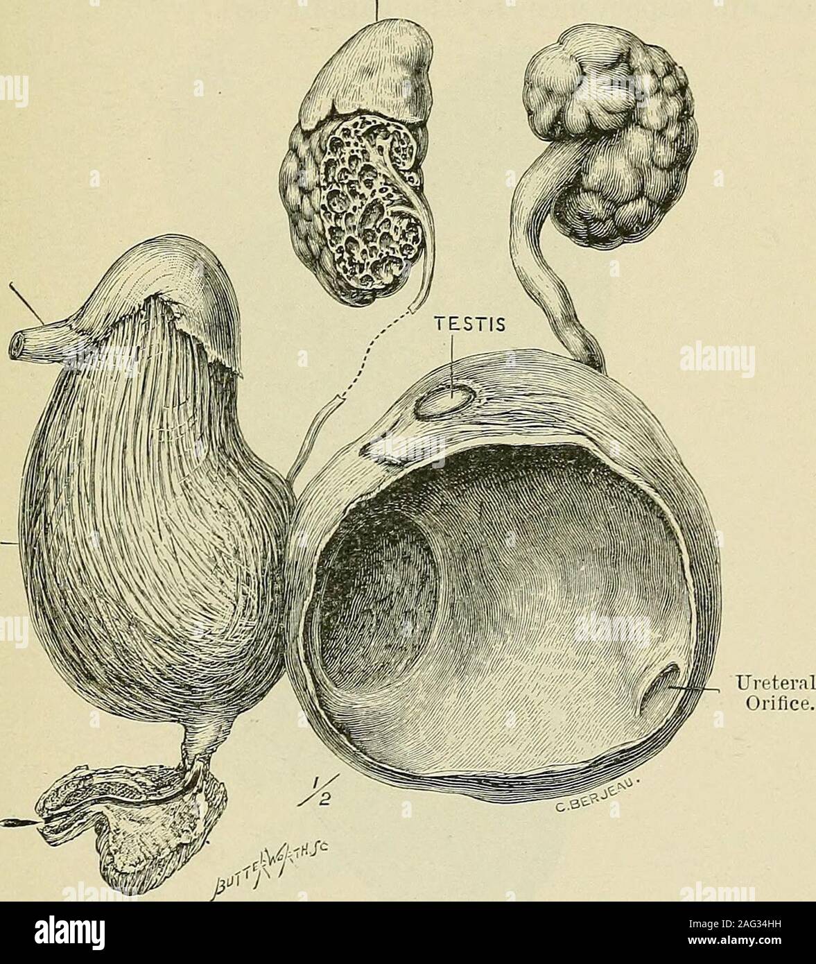 Histologie Du Kyste Du Canal Gartner