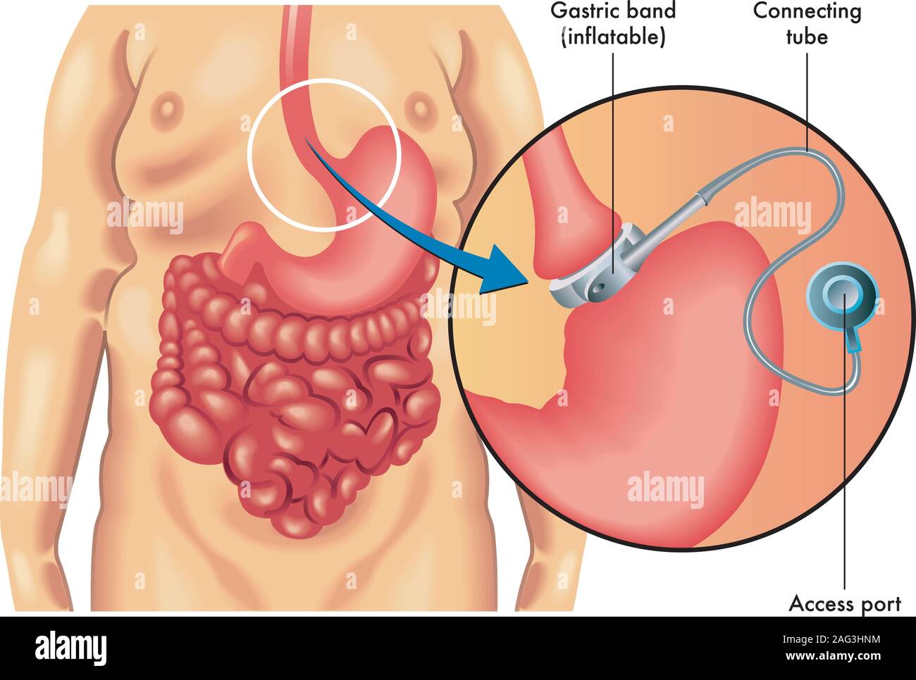 Illustration médicale d'un cerclage gastrique ajustable. Illustration de Vecteur