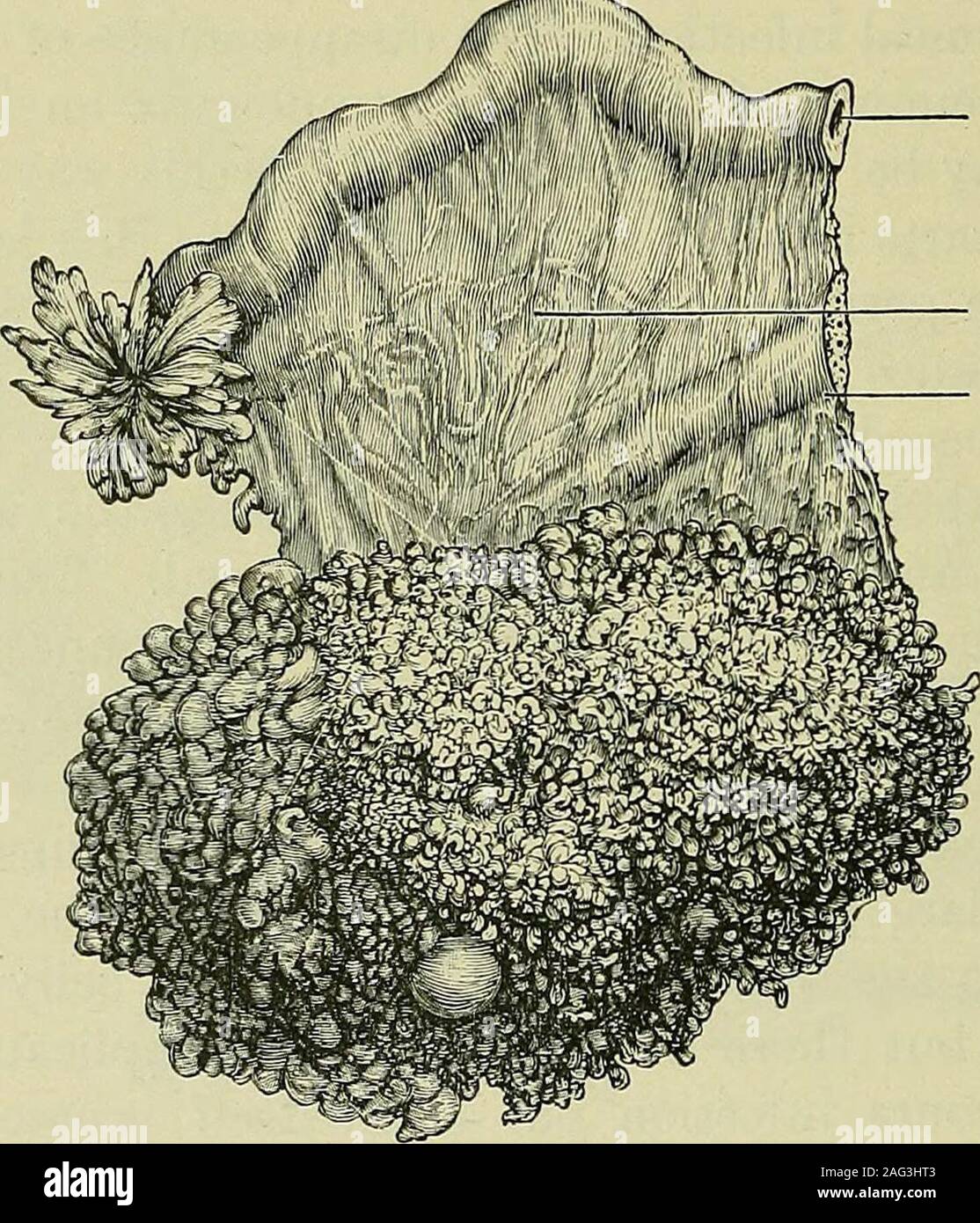 . Les tumeurs, malignes et innocentes ; leurs caractères cliniques et le traitement approprié. verrues, maladie des trompes, et ainsi de suite. Hydroperitoneum est une constante de l'éclatement d'une kyste papillomatous. Lorsque le kyste est re-déplacé l'exsudation cesse. Un des exemples les plus remarquables d'hydroperito-neum associé à des kystes papillomatous sur fiche est thatdescribed par le Dr Pye-Smith. Dans ce cas, une femme wastapped hydroperitoneum pour, entre août 1884 et avril 1894, 299,fois. Sur la réadmission pour le 300e en appuyant sur shedied. À l'autopsie un kyste papillomatous tumeurs 512 Banque D'Images