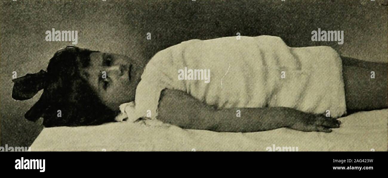 . La pratique de la pédiatrie. être supprimée, car, si elle est poursuivie plus longtemps, trop-reduc tion peut avoir lieu. Si la fièvre s'élève à nouveau rapidement à 105° F. ou plus,il est bien de garder le patient dans l'emballage en continu. Ofcold le degré nécessaire, dans chaque cas, de maintenir la température limite withinsafe sera bientôt appris. Récemment, j'ai conservé dans un pack pour soixante-douze heures, un garçon âgé de quatre ans avec la pneumonie lobaire. Dans ce pack de 70 continu casea° F. était nécessaire pour maintenir la température à 104° F. ou légèrement plus bas. Une autre raison pour prendre fréquemment la température est que, Banque D'Images