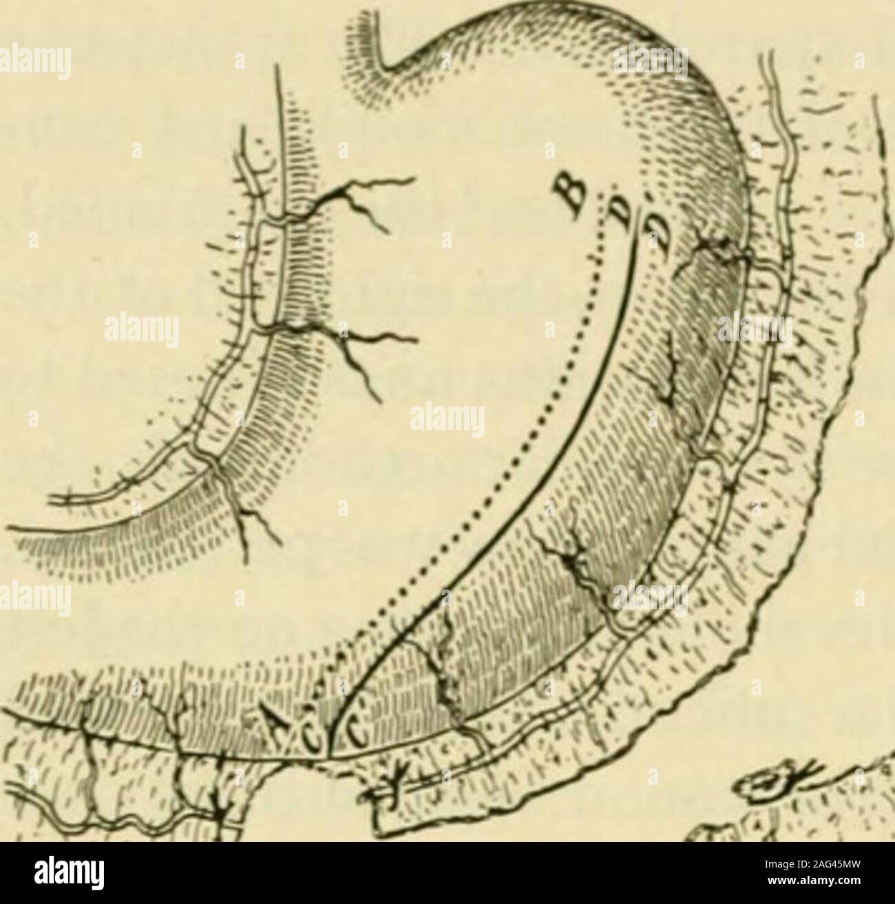 . Manuel de chirurgie opératoire. alls de l'estomac le long de la ligne A B, Fig. 353. (Avec un machinedevised Hiiltl par complexe, Willy Meyer dans un seul mouvement insère une ligne double d'wirestitches le long d'un B et coupe entre, ce qui économise du temps et de l'encrassement.) inciser le ventre (les deux murs) le long de la ligne CD. Fermer le volet ofstomach entre la coupe et CD la grande courbure par une double ligne ofsutures (CD) de manière à former en un tube ouvert à son extrémité distale (C) et continue avec le con-cardia à D.D. Ce tube est bien nourrie par le PHARYNGOTOMY LAKYXGOTOMY 230 gauche et gastro-graisse épiploïque navires. Bury Banque D'Images