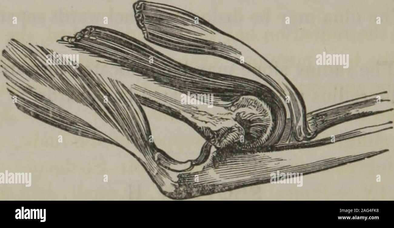 . Un traité sur les fractures et luxations des articulations. hat causé le déplacement. En outre, en vertu de l'un de ces accidents, les motions de l'articulation du coude sont mais slightlyinterfered avec, bien que ceux de l'articulation radio-ulnaire sont entièrement perdu, et la possibilité d'une supination pronation et par conséquent exclu.-Ed. t l'olécrâne, dit Boyer, est dans cette dislocation placés plus haut que condyle externe, au lieu d'être sur un niveau avec elle, car elle est naturellement. 382 La DISLOCATION DU RADIUS ET DU CUBITUS de l'olécrâne apparaît un creux. Un gonflement dur à isfelt e Banque D'Images