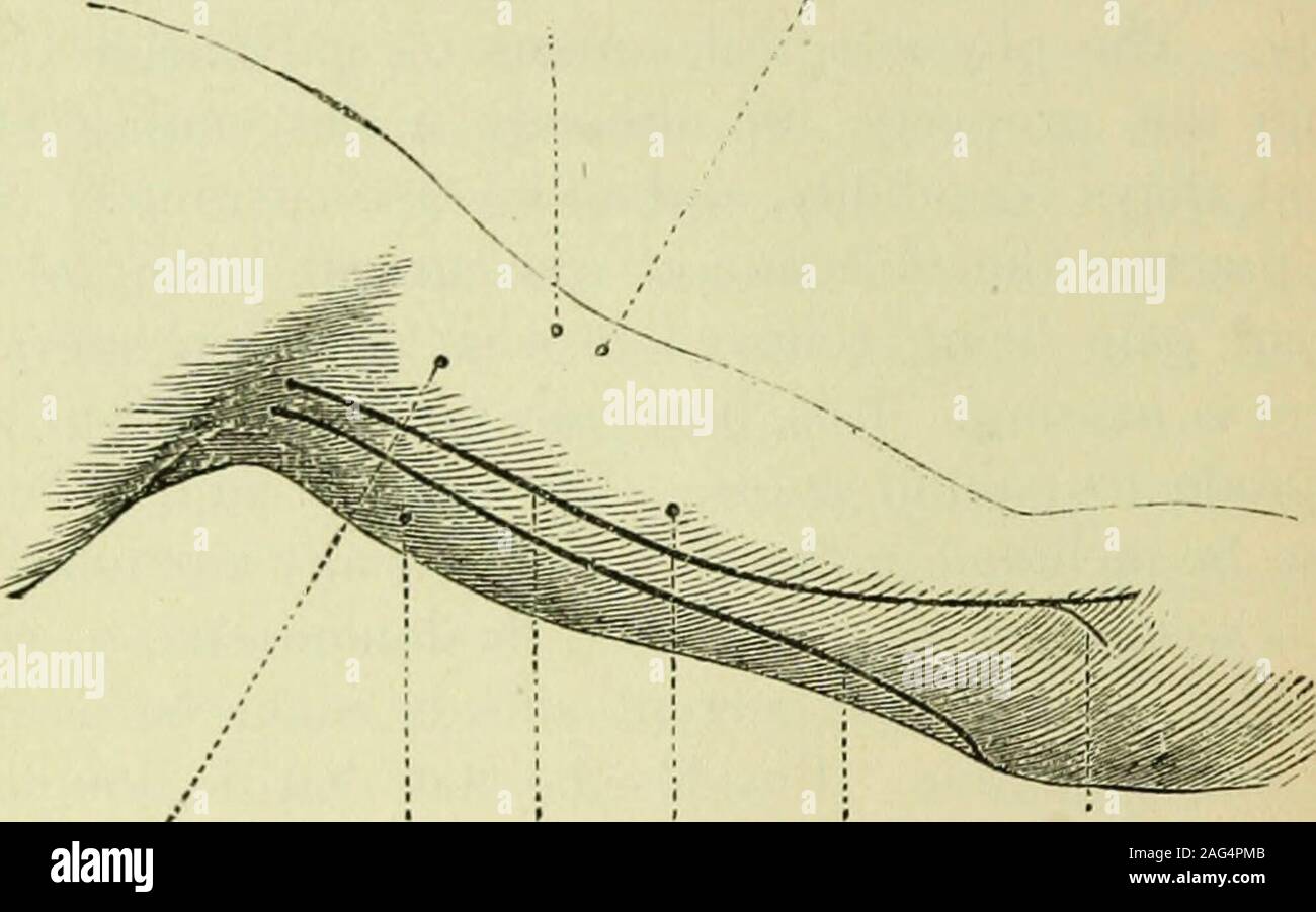 . L'électricité médicale ; un traité pratique sur les applications de l'électricité pour la médecine et la chirurgie. l'infra- et supra-orbitaldivisions de la cinquième, dû au froid, les dents carieuses, etc., thepain persistant après la cause est supprimée. Il est vrai, dans la main, qui n'est qu'en soins palliatifs galvanisme neuralgiaof la cinquième. Cette opinion est confirmée par Anstie,1 Bene-dict,2 et d'autres observateurs bien différent, c'est l'effet sur ofgalvanism brackial névralgies cervico-. Dans un grand 1 et ses contrefaçons, névralgie, p. 200 et suiv. 2 Electrotherapie, op. cit. 14 210 expérience électro-thérapeutique. je Banque D'Images