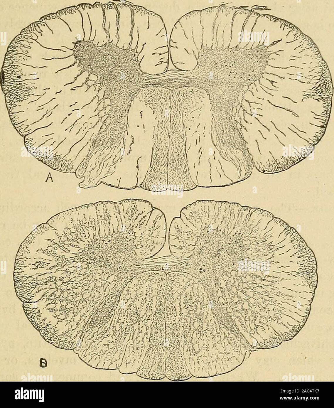 . Un manuel des maladies du système nerveux. la huitième cervicaux (Fig. 103, b) opaquetracts s'étendre à travers la matière grise et blanche, et il tothese adjacente est partout une vaste destruction des fibres nerveuses. Inthese étendues dans les colonnes latérales d'un grand nombre de très minutenerve-fibres peuvent être vus, composés chacun d'une amende axis-cyhnder sur-arrondi par la myéline (Fig. 104, c). Les fibres sont plus petites que anymet avec dans le cordon d'alimentation normale. L'apparence est comme s'il hadbeen une myélite ascendante, qui a prolongé jusqu'thecord aussi haut que entre les septième et huitième cervic Banque D'Images . Un manuel des maladies du système nerveux. la huitième cervicaux (Fig. 103, b) opaquetracts s'étendre à travers la matière grise et blanche, et il tothese adjacente est partout une vaste destruction des fibres nerveuses. Inthese étendues dans les colonnes latérales d'un grand nombre de très minutenerve-fibres peuvent être vus, composés chacun d'une amende axis-cyhnder sur-arrondi par la myéline (Fig. 104, c). Les fibres sont plus petites que anymet avec dans le cordon d'alimentation normale. L'apparence est comme s'il hadbeen une myélite ascendante, qui a prolongé jusqu'thecord aussi haut que entre les septième et huitième cervic Banque D'Images