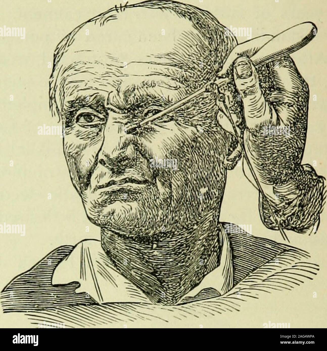 . L'électricité médicale ; un traité pratique sur les applications de l'électricité pour la médecine et la chirurgie. uadratus menti inclusivement, démontrer les mouvements en chef de l'musclesof expression innervé par le septième nerf, et indi-cate la position des électrodes lorsque les muscles areto être jeté dans l'action de la stimulation galvanique ou faradic. 1 Progres medicale, 23-30 avril, 1S81. 190 L'ÉLECTRO-Therapeutics.KlG. 69.. Levator labii superions que^ala nasi.fic. 70. Banque D'Images . L'électricité médicale ; un traité pratique sur les applications de l'électricité pour la médecine et la chirurgie. uadratus menti inclusivement, démontrer les mouvements en chef de l'musclesof expression innervé par le septième nerf, et indi-cate la position des électrodes lorsque les muscles areto être jeté dans l'action de la stimulation galvanique ou faradic. 1 Progres medicale, 23-30 avril, 1S81. 190 L'ÉLECTRO-Therapeutics.KlG. 69.. Levator labii superions que^ala nasi.fic. 70. Banque D'Images