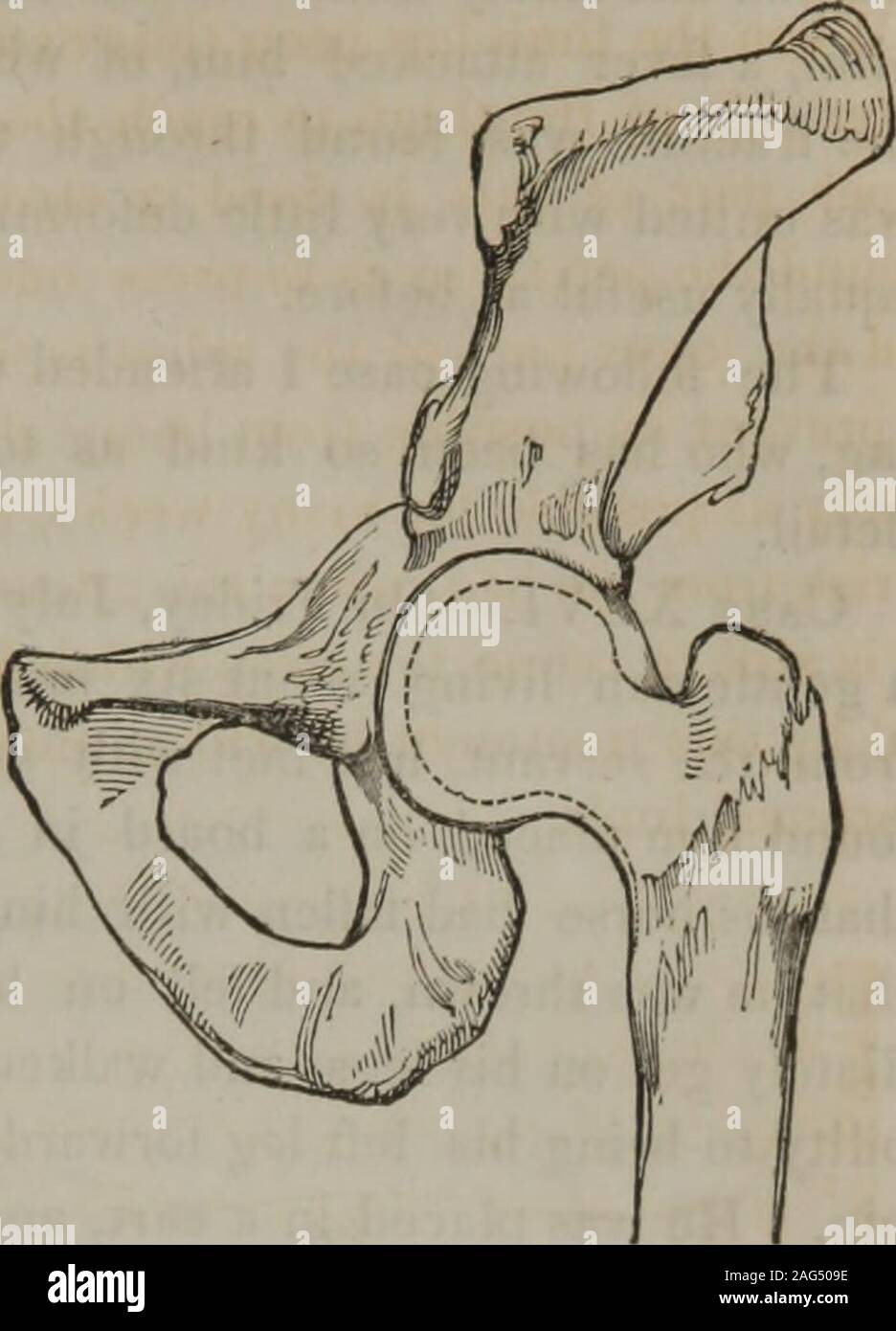 . Un traité sur les fractures et luxations des articulations. Les symptômes sont les suivants :-isbut la jambe peu, et parfois, pas du tout plus courte que l'autre ; le isbenumbed pied ; et dans certains cas, le patient est incapable de tourner dans bedwithout, et la tentative d'assistance lui donne beaucoup de douleur. L'limbis éversée considérablement ; le patient ne peut s'asseoir, et toute tentative de faire soproduces la douleur excessive. La partie cassée du trochanter * La construction de ce plan incliné est tellement compliqué, qu'il peut hemade à l'instant, de deux amas commun, dont celle d'il throughnearly scié à la Banque D'Images